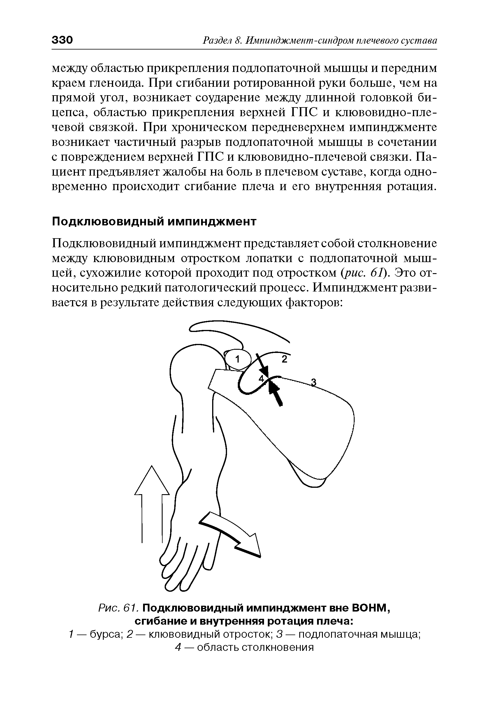 Рис. 61. Подклювовидный импинджмент вне ВОНМ, сгибание и внутренняя ротация плеча ...