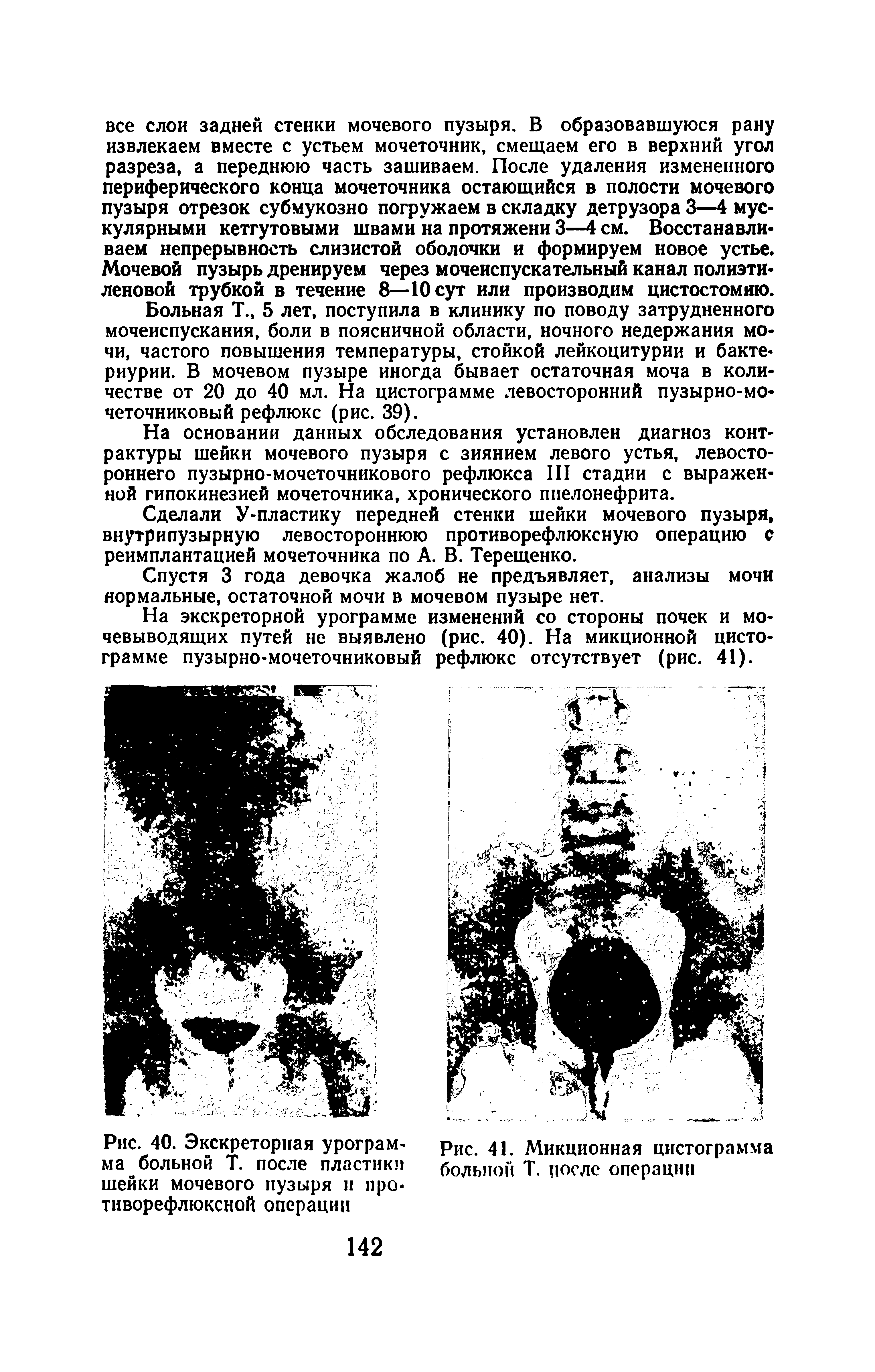 Рис. 40. Экскреторная урограмма больной Т. после пластики шейки мочевого пузыря и про-тиворефлюксной операции...