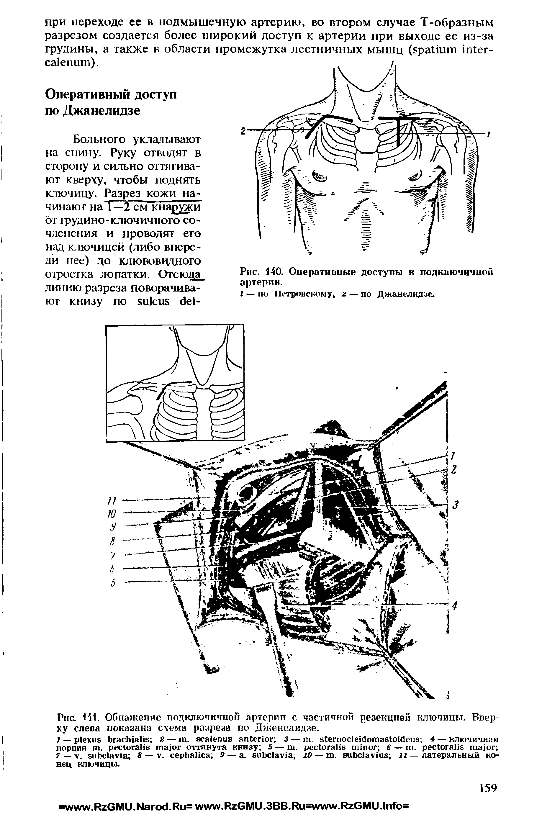 Рис. 111. Обнажение подключичной артерии с частичной резекцией ключицы. Вверху слева показана схема разреза по Дженелидзе.