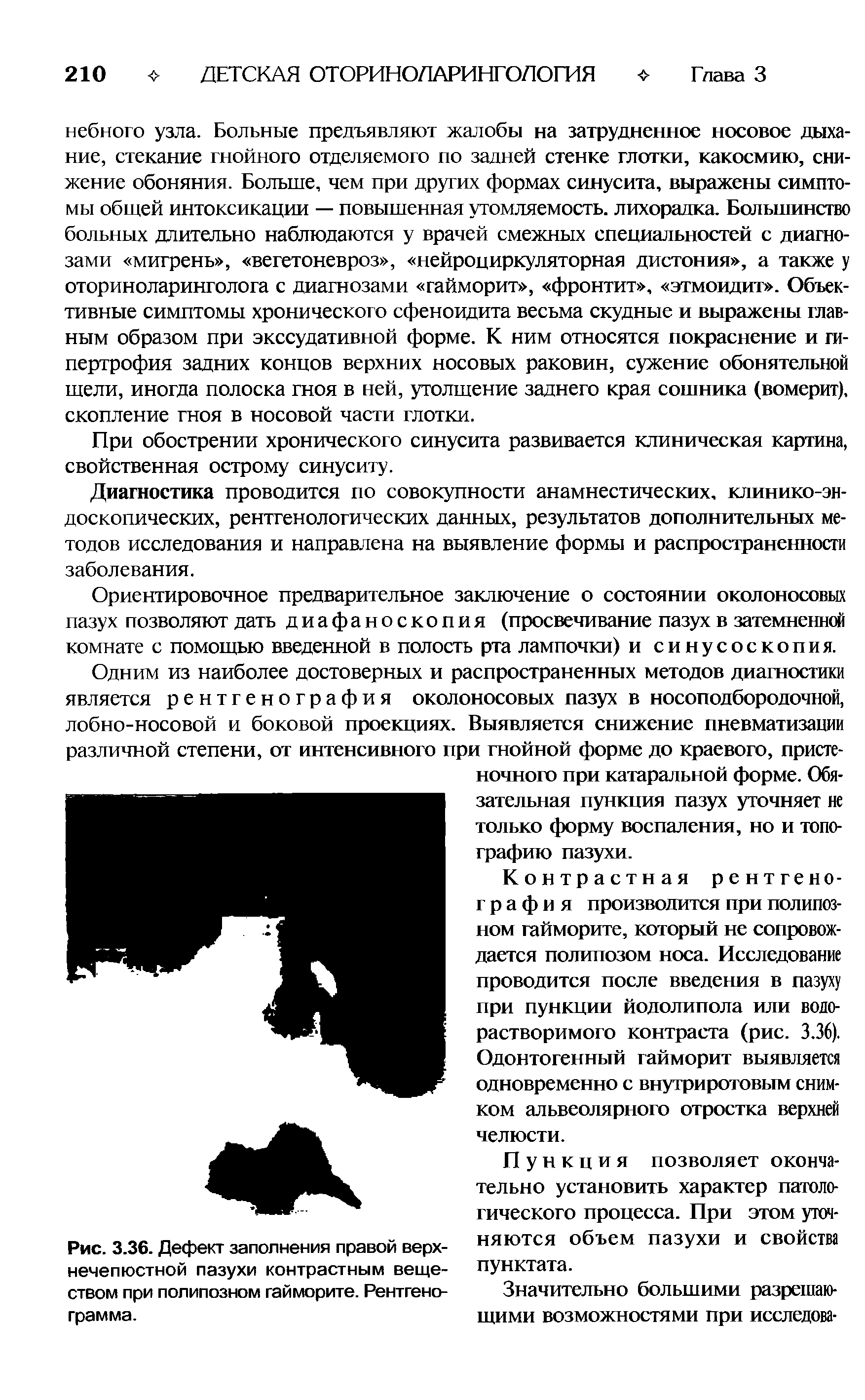 Рис. 3.36. Дефект заполнения правой верхнечелюстной пазухи контрастным веществом при полипозном гайморите. Рентгенограмма.