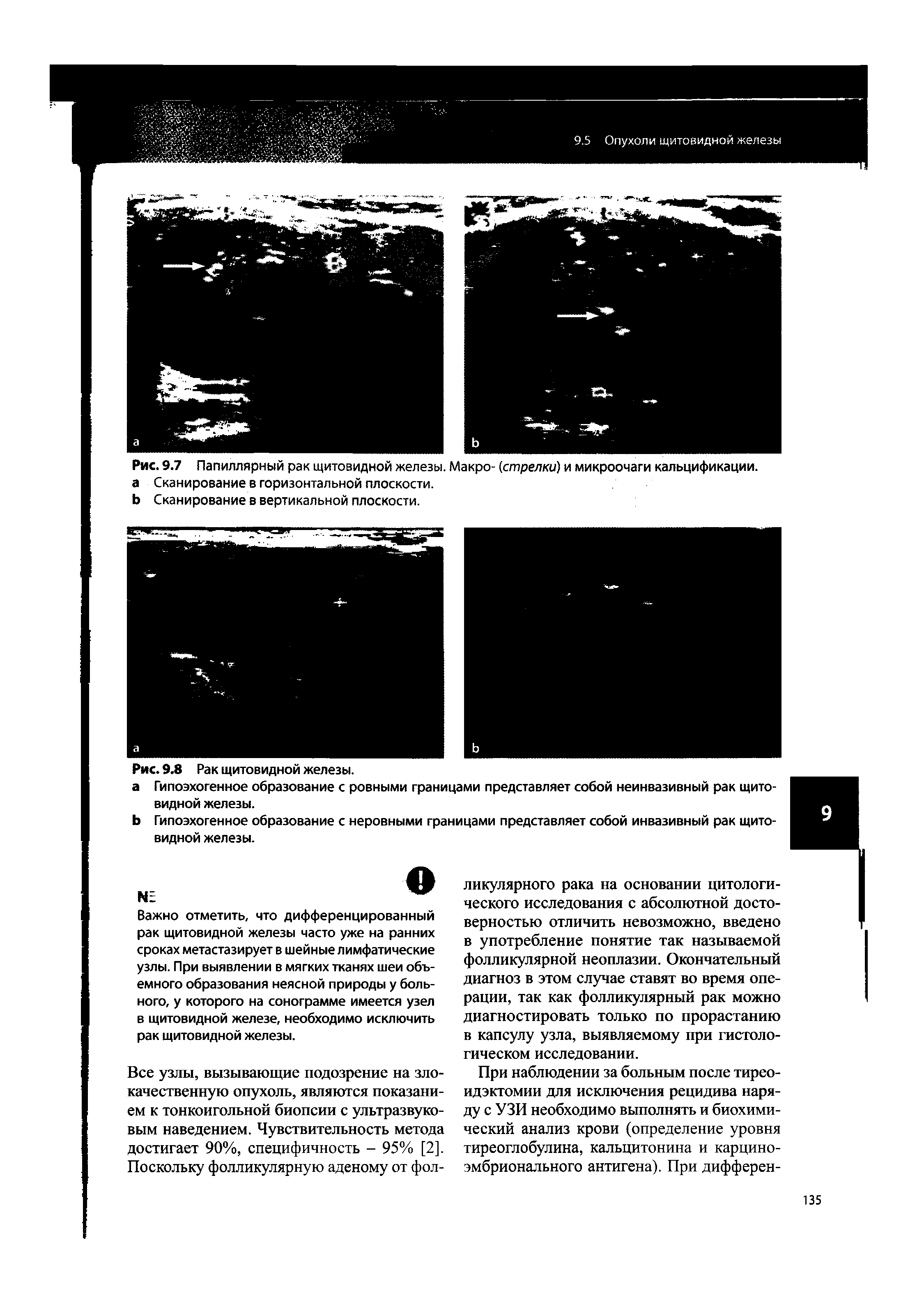 Рис. 9.7 Папиллярный рак щитовидной железы. Макро- (стрелки) и микроочаги кальцификации, а Сканирование в горизонтальной плоскости.