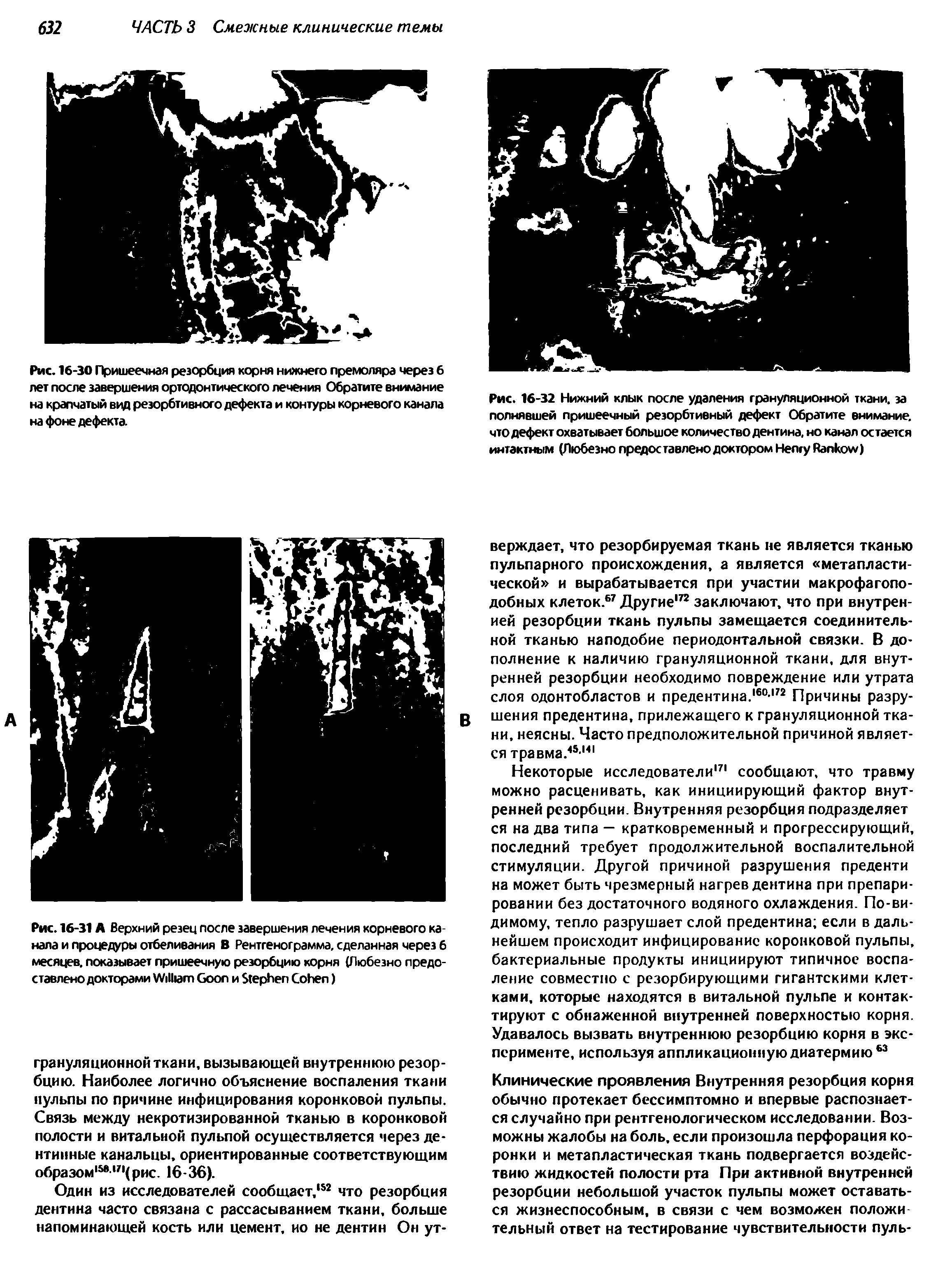 Рис. 16-31А Верхний резец после завершения лечения корневого канала и процедуры отбеливания В Рентгенограмма, сделанная через б месяцев, показывает пришеечную резорбцию корня (Любезно предоставлено докторами W G и S C )...