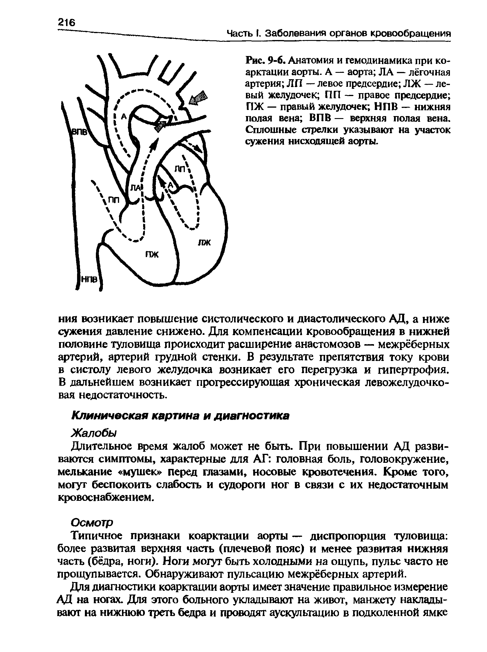 Рис. 9-6. Анатомия и гемодинамика при коарктации аорты. А — аорта ЛА — лёгочная артерия ЛП — левое предсердие ЛЖ — левый желудочек ПП — правое предсердие ПЖ — правый желудочек НПВ — нижняя полая вена ВПВ — верхняя полая вена. Сплошные стрелки указывают на участок сужения нисходящей аорты.