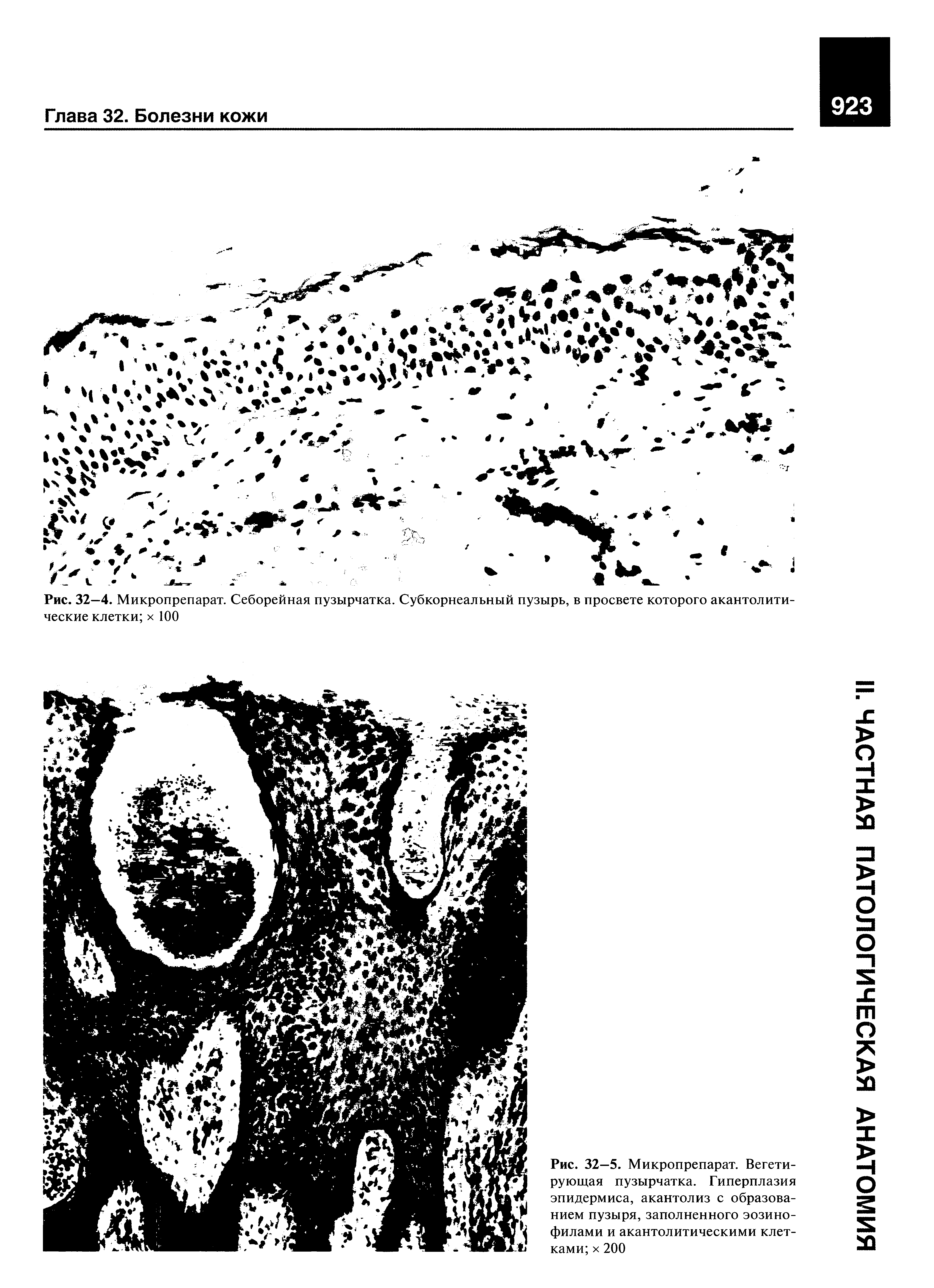 Рис. 32—5. Микропрепарат. Вегетирующая пузырчатка. Гиперплазия эпидермиса, акантолиз с образованием пузыря, заполненного эозинофилами и акантолитическими клетками х 200...