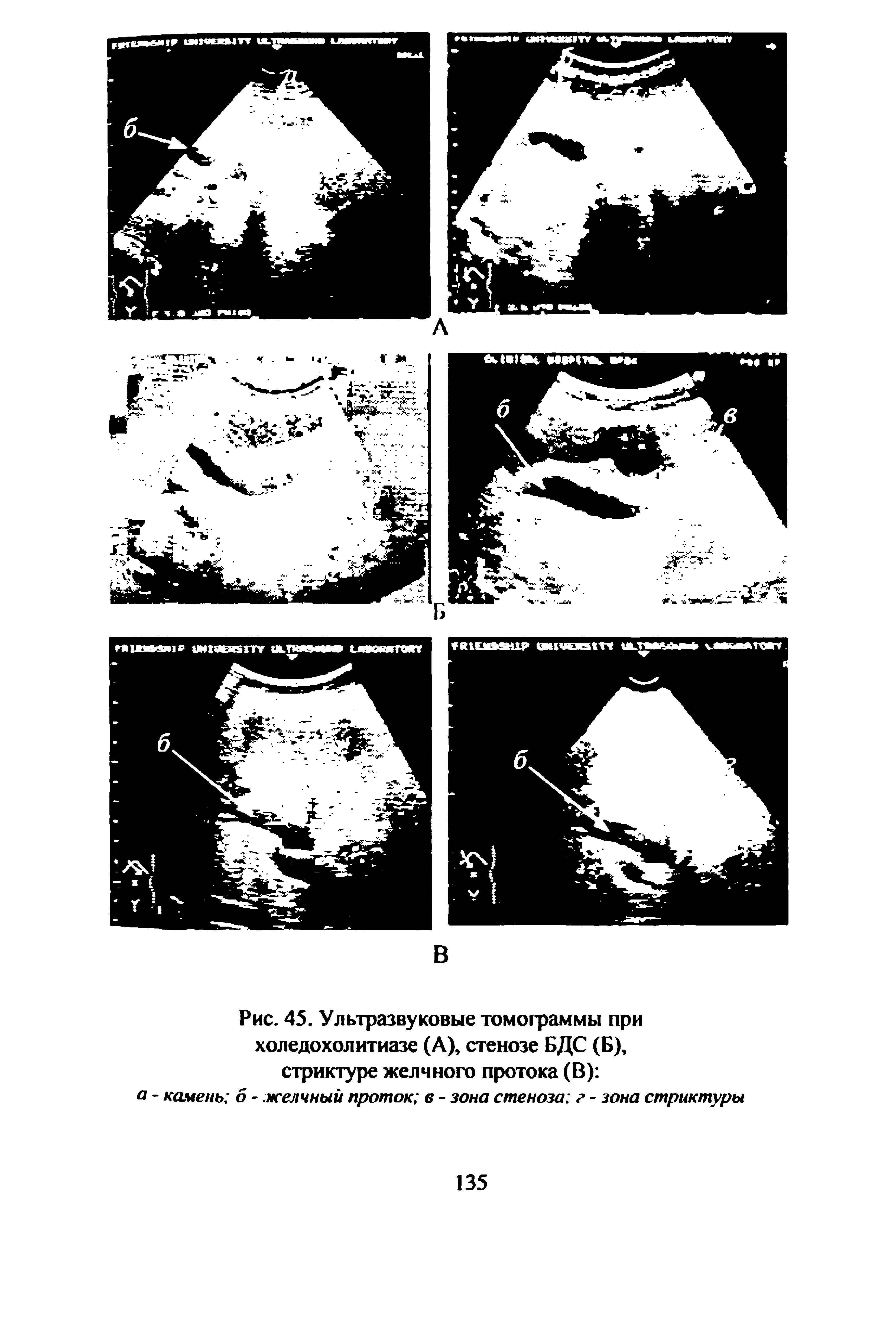 Рис. 45. Ультразвуковые томограммы при холедохолитиазе (А), стенозе БДС (Б), стриктуре желчного протока (В) а - камень б - желчный проток в - зона стеноза г - зона стриктуры...