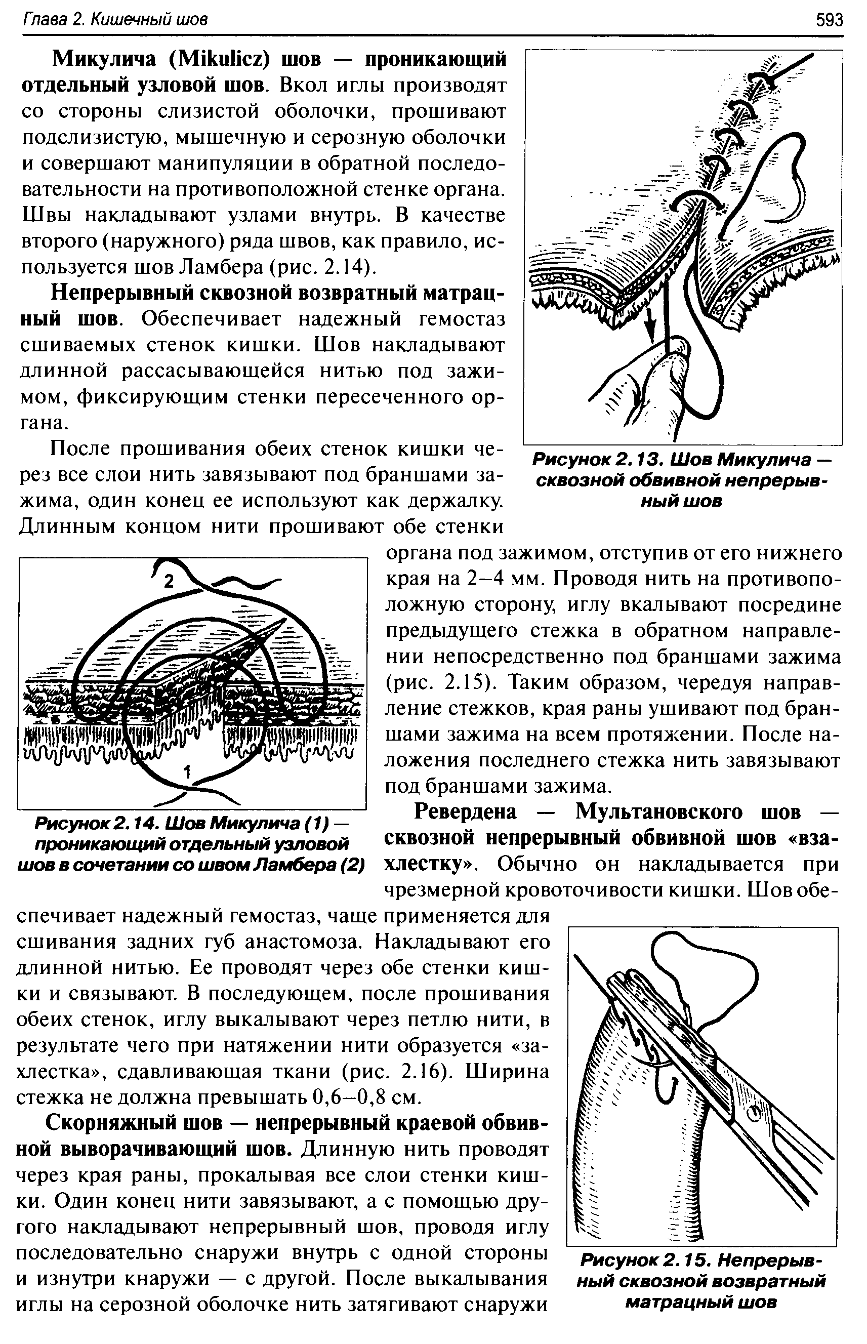 Рисунок 2.14. Шов Микулича (1) — проникающий отдельный узловой шов в сочетании со швом Ламбера (2)...