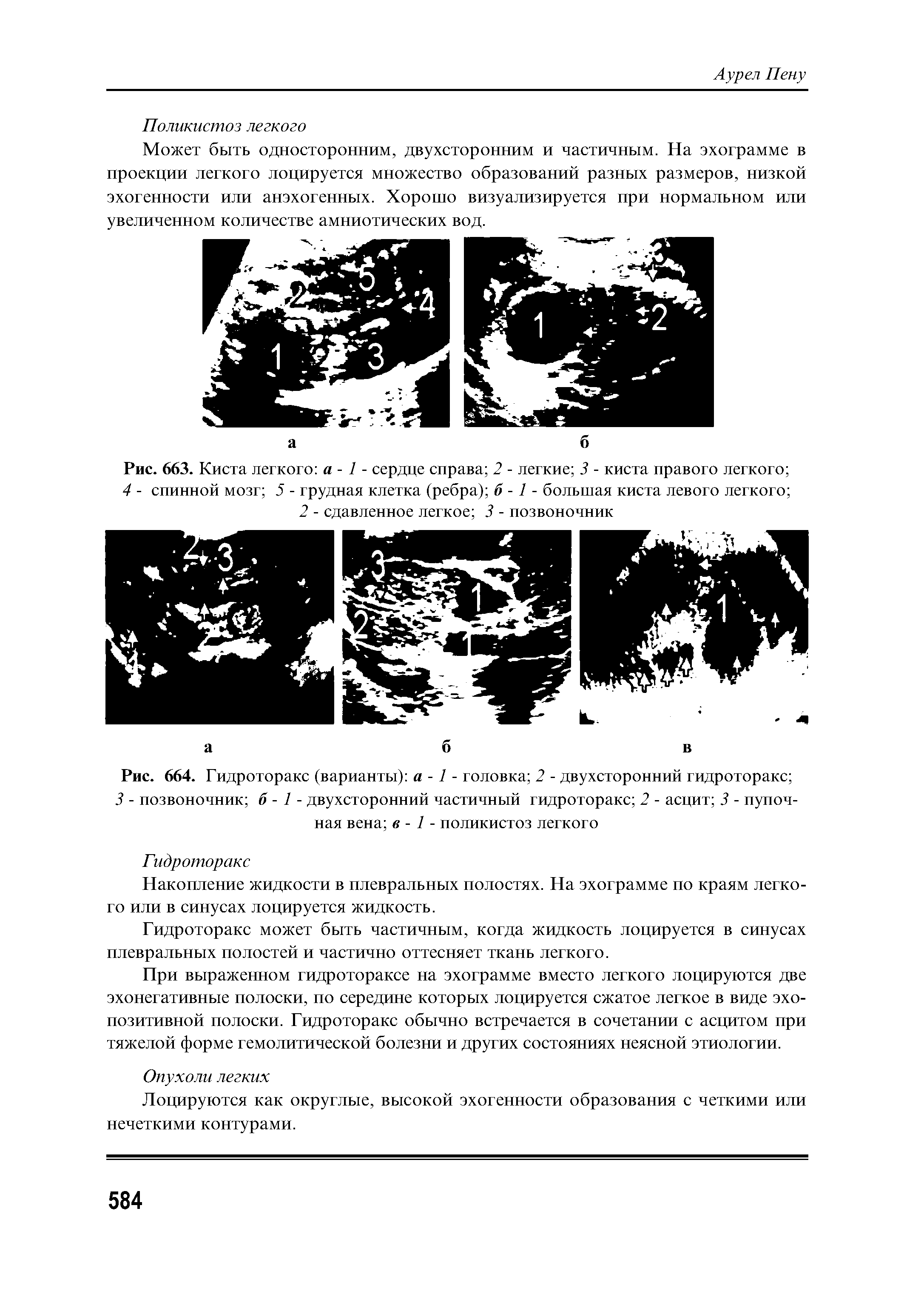 Рис. 663. Киста легкого а - 1 - сердце справа 2 - легкие 3 - киста правого легкого 4 - спинной мозг 5 - грудная клетка (ребра) б -1 - большая киста левого легкого ...