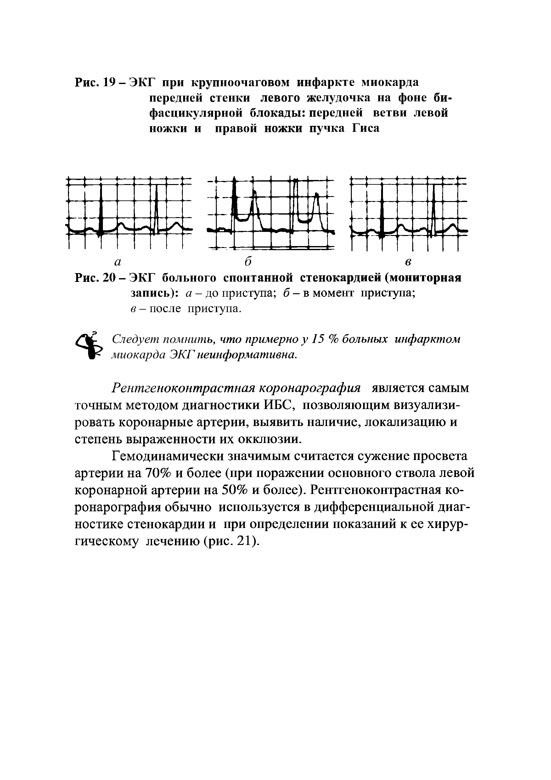 Рис. 20 - ЭКГ больного спонтанной стенокардией (мониторная запись) а - до приступа б - в момент приступа ...