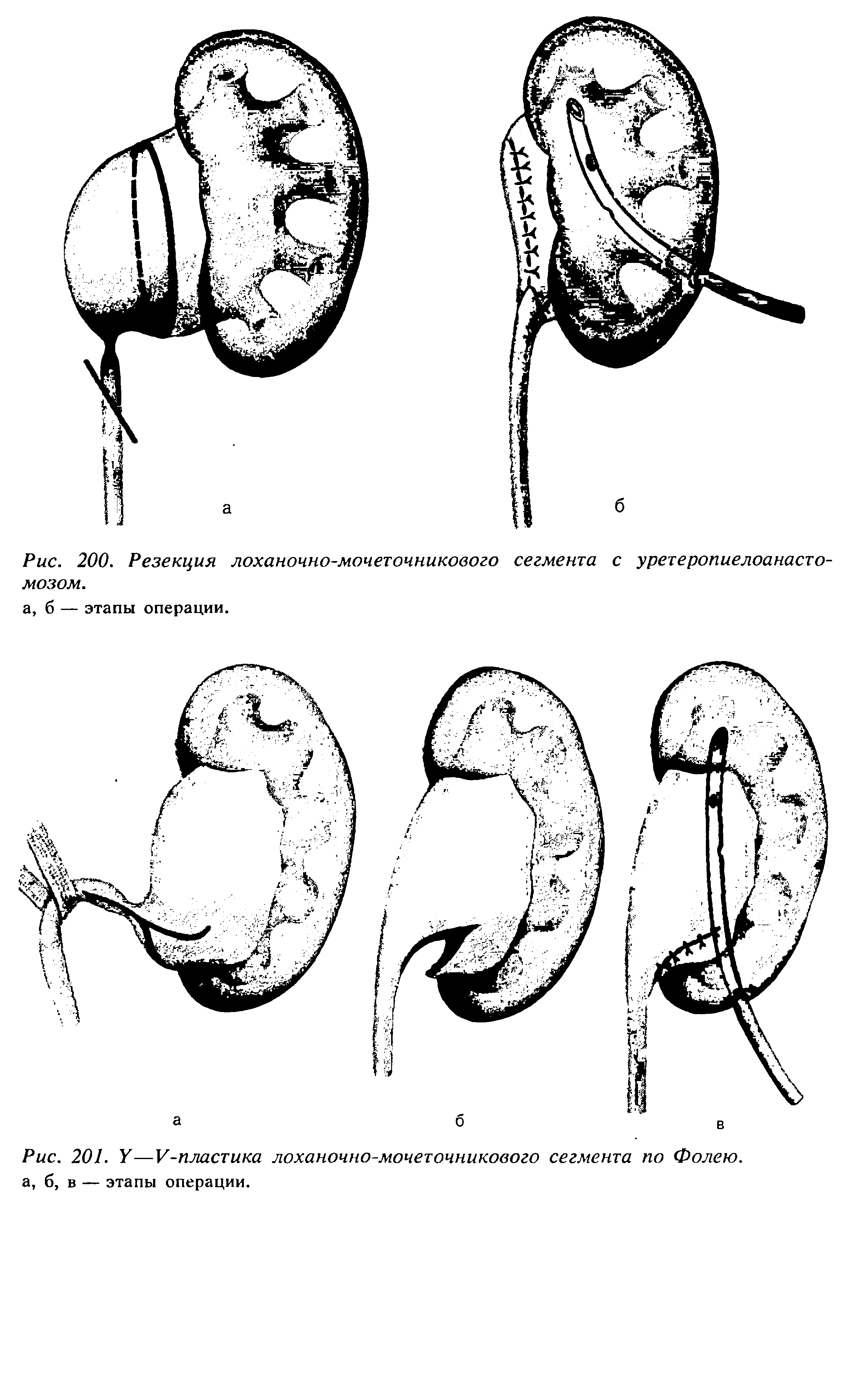 Рис. 201. У—У-пластика лоханочно-мочеточникового сегмента по Фолею. а, б, в — этапы операции.