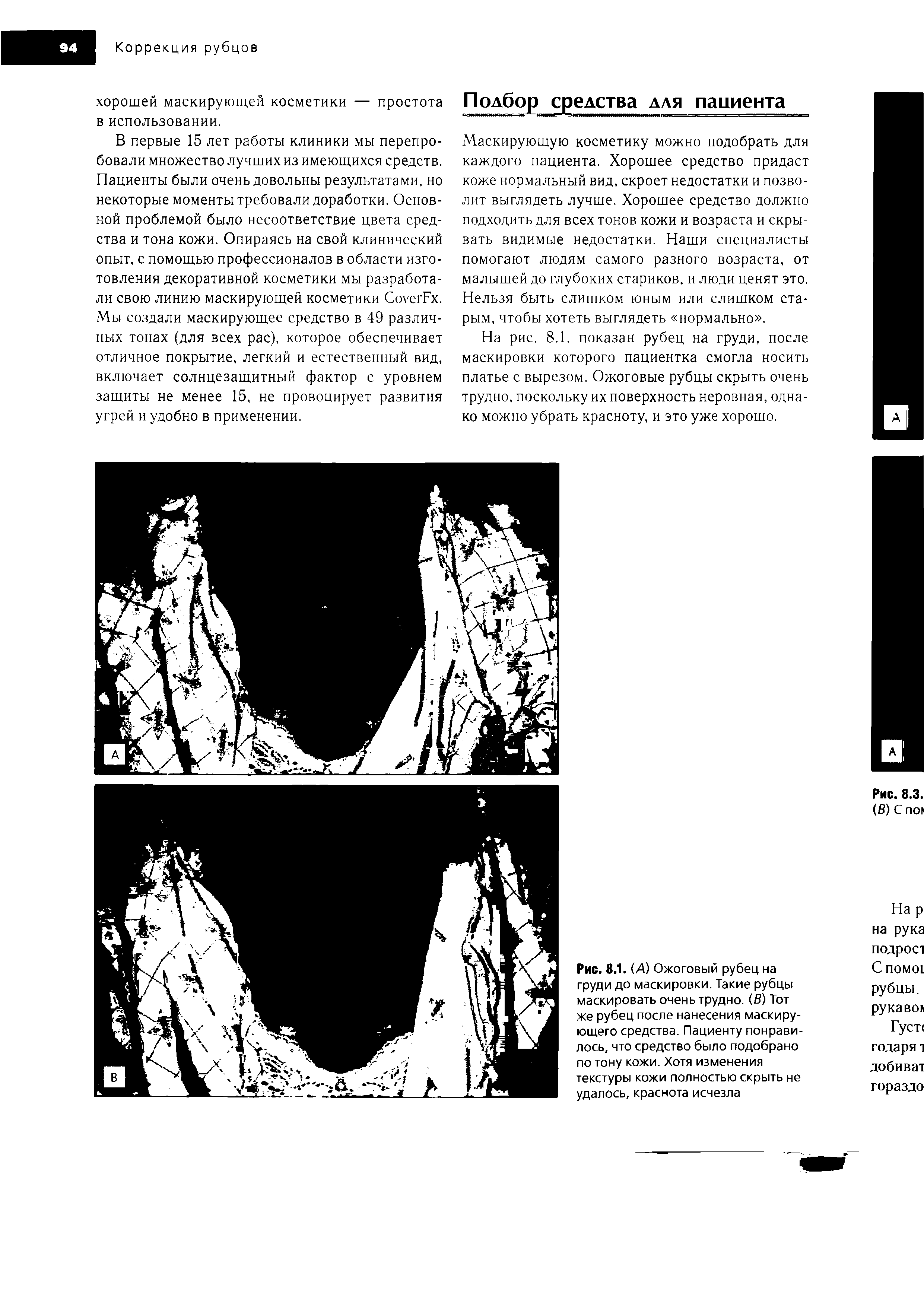 Рис. 8.1. (А) Ожоговый рубец на груди до маскировки. Такие рубцы маскировать очень трудно. (В) Тот же рубец после нанесения маскирующего средства. Пациенту понравилось, что средство было подобрано по тону кожи. Хотя изменения текстуры кожи полностью скрыть не удалось, краснота исчезла...