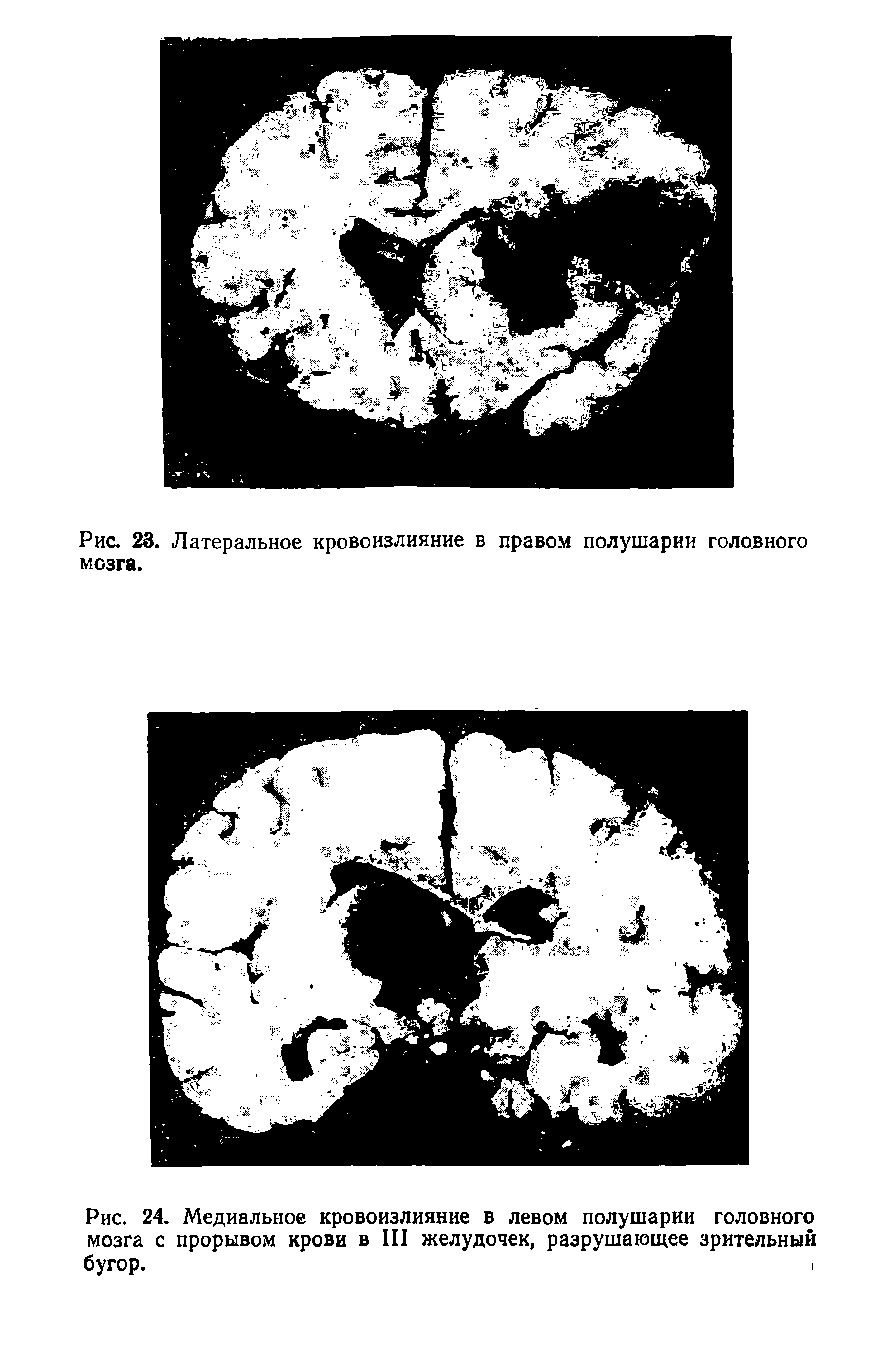 Рис. 24. Медиальное кровоизлияние в левом полушарии головного мозга с прорывом крови в III желудочек, разрушающее зрительный бугор.