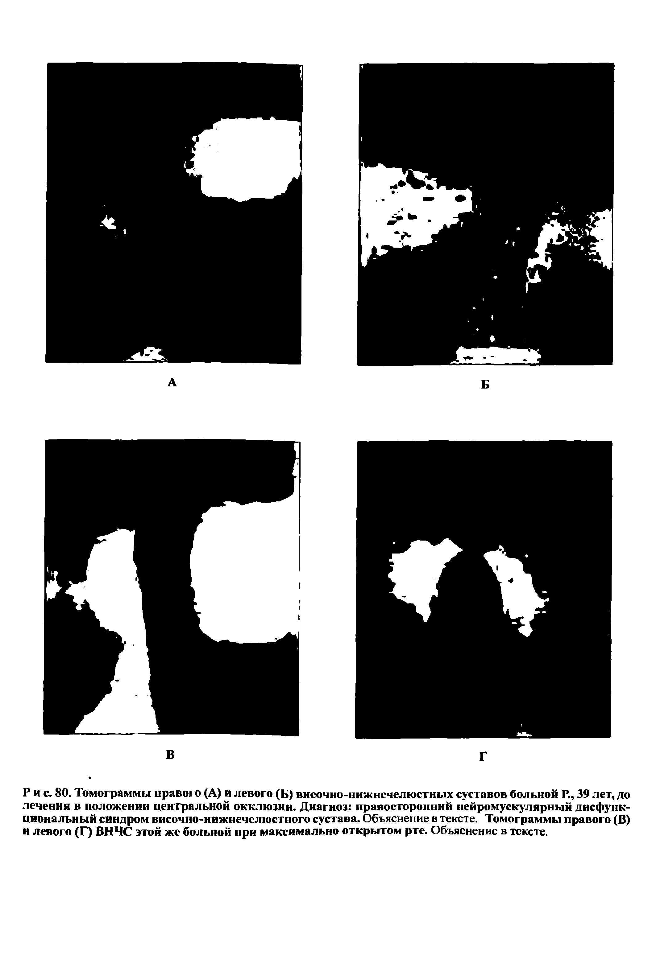 Рис. 80. Томограммы правого (А) и левого (Б) височно-нижнечелюстных суставов больной Р., 39 лет, до лечения в положении центральной окклюзии. Диагноз правосторонний нейромускулярный дисфункциональный синдром височно-нижнечелюстного сустава. Объяснение в тексте. Томограммы правого (В) и левого (Г) ВНЧС этой же больной при максимально открытом рте. Объяснение в тексте.