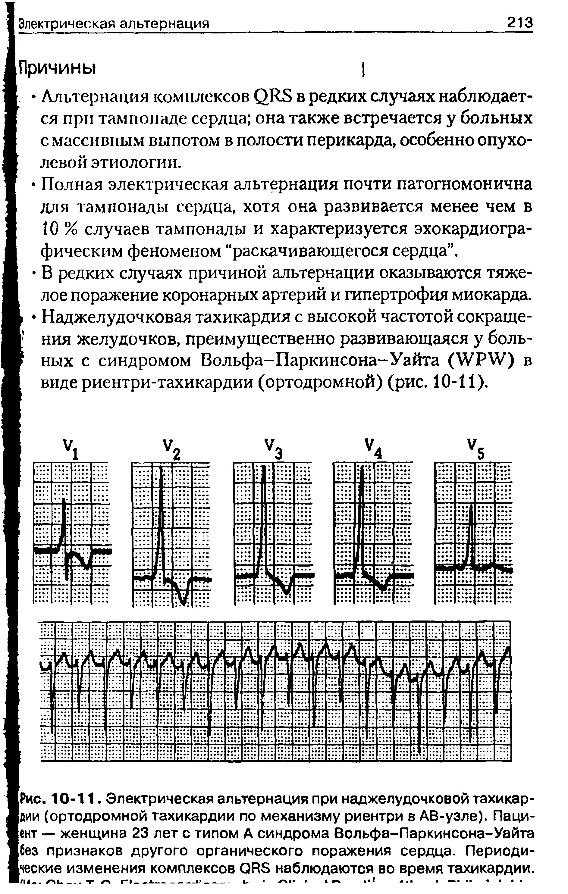 Рис. 10-11. Электрическая альтернация при наджелудочковой тахикардии (ортодромной тахикардии по механизму риентри в АВ-узле). Пациент — женщина 23 лет с типом А синдрома Вольфа-Паркинсона-Уайта без признаков другого органического поражения сердца. Периодические изменения комплексов ОАЭ наблюдаются во время тахикардии.