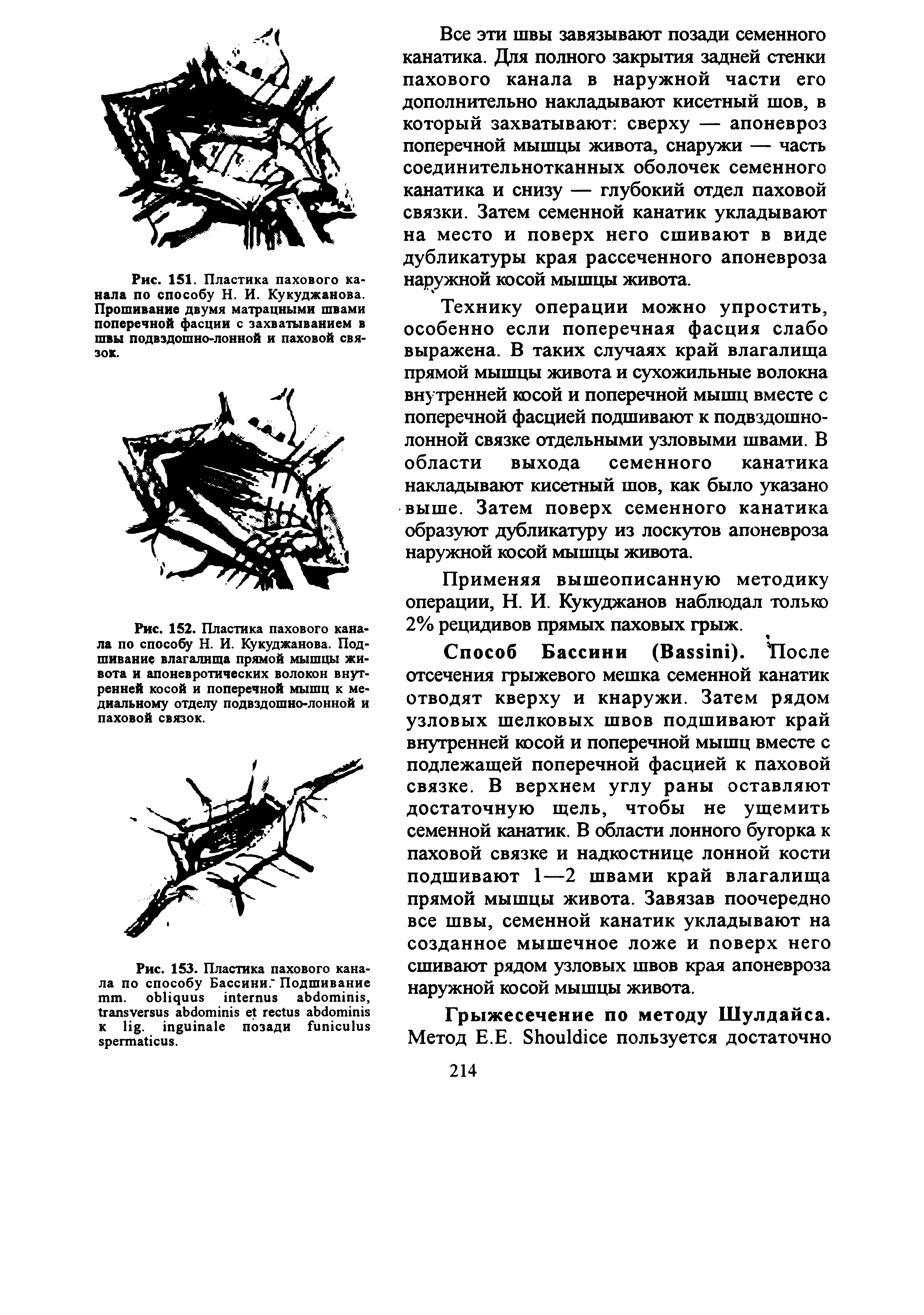 Рис. 153. Пластика пахового канала по способу Бассини. Подшивание . , к . позади .