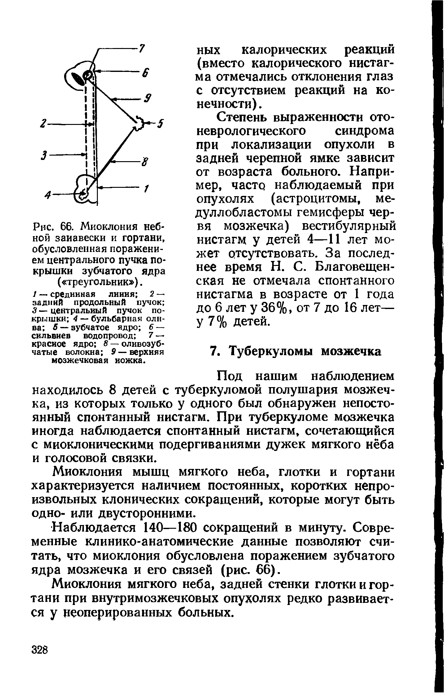 Рис. 66. Миоклония небной занавески и гортани, обусловленная поражением центрального пучка покрышки зубчатого ядра ( треугольник ).