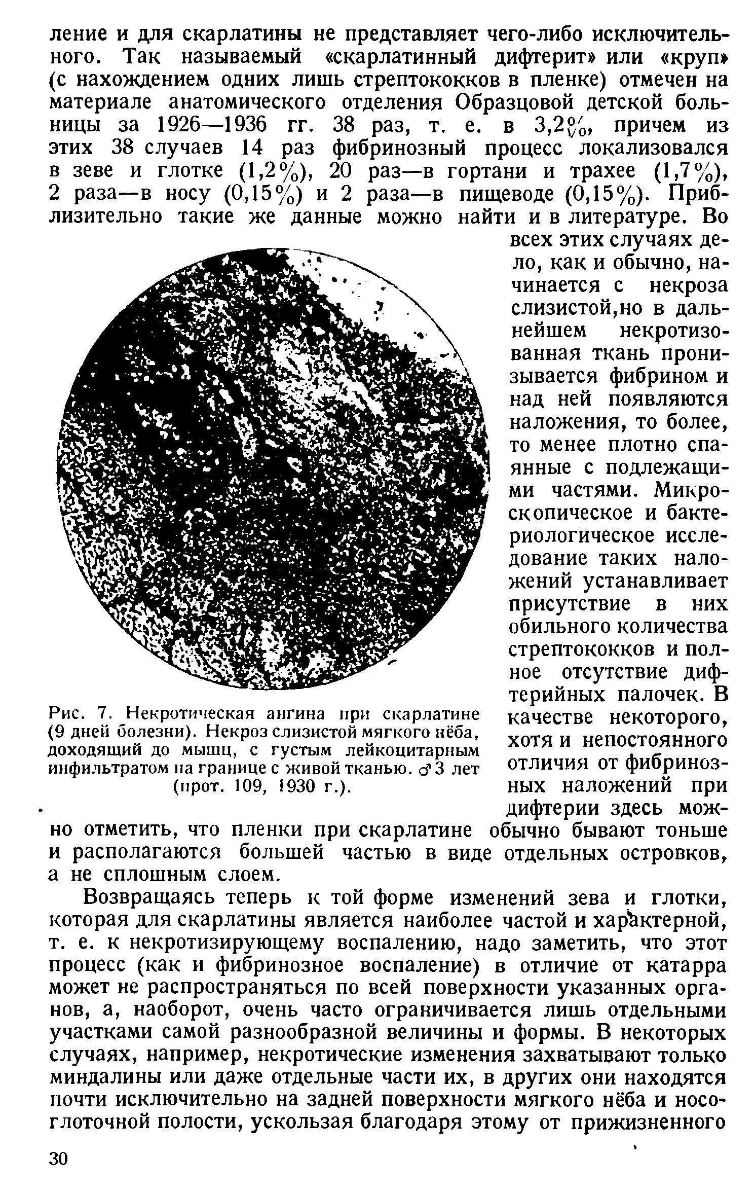 Рис. 7. Некротическая ангина при скарлатине (9 дней болезни). Некроз слизистой мягкого нёба, доходящий до мышц, с густым лейкоцитарным инфильтратом па границе с живой тканью. сГ 3 лет (прот. 109, 1930 г.).