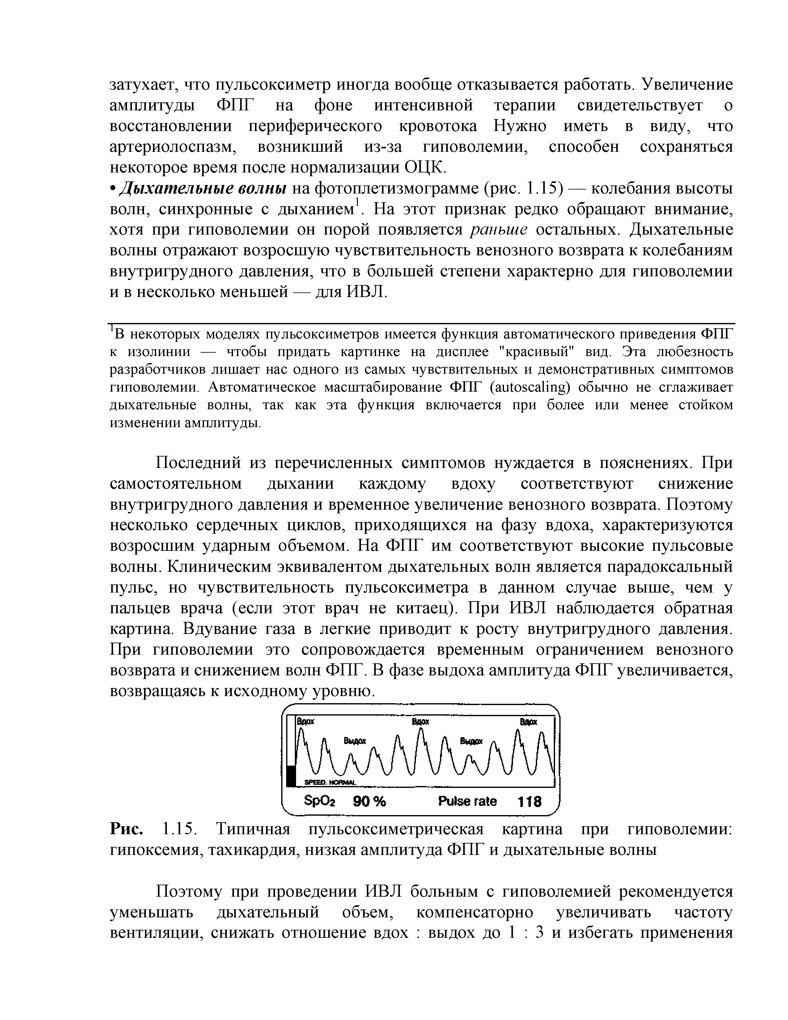 Рис. 1.15. Типичная пульсоксиметрическая картина при гиповолемии гипоксемия, тахикардия, низкая амплитуда ФПГ и дыхательные волны...