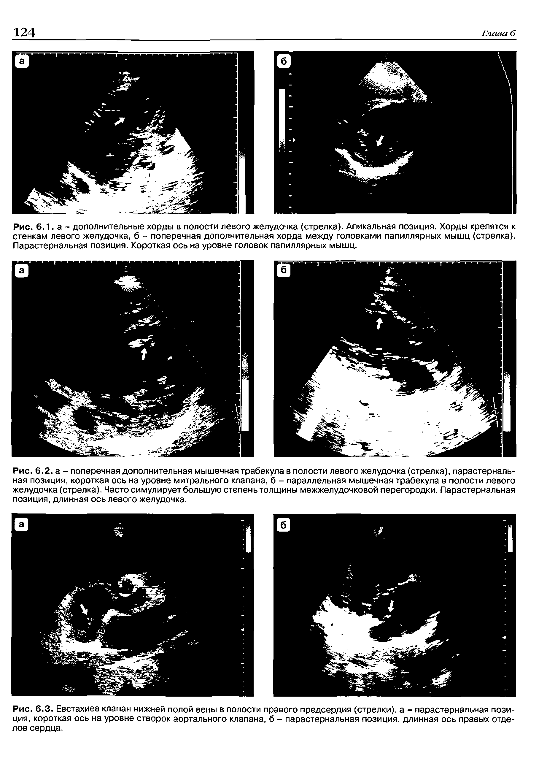 Рис. 6.3. Евстахиев клапан нижней полой вены в полости правого предсердия (стрелки), а - парастернальная позиция, короткая ось на уровне створок аортального клапана, б - парастернальная позиция, длинная ось правых отделов сердца.