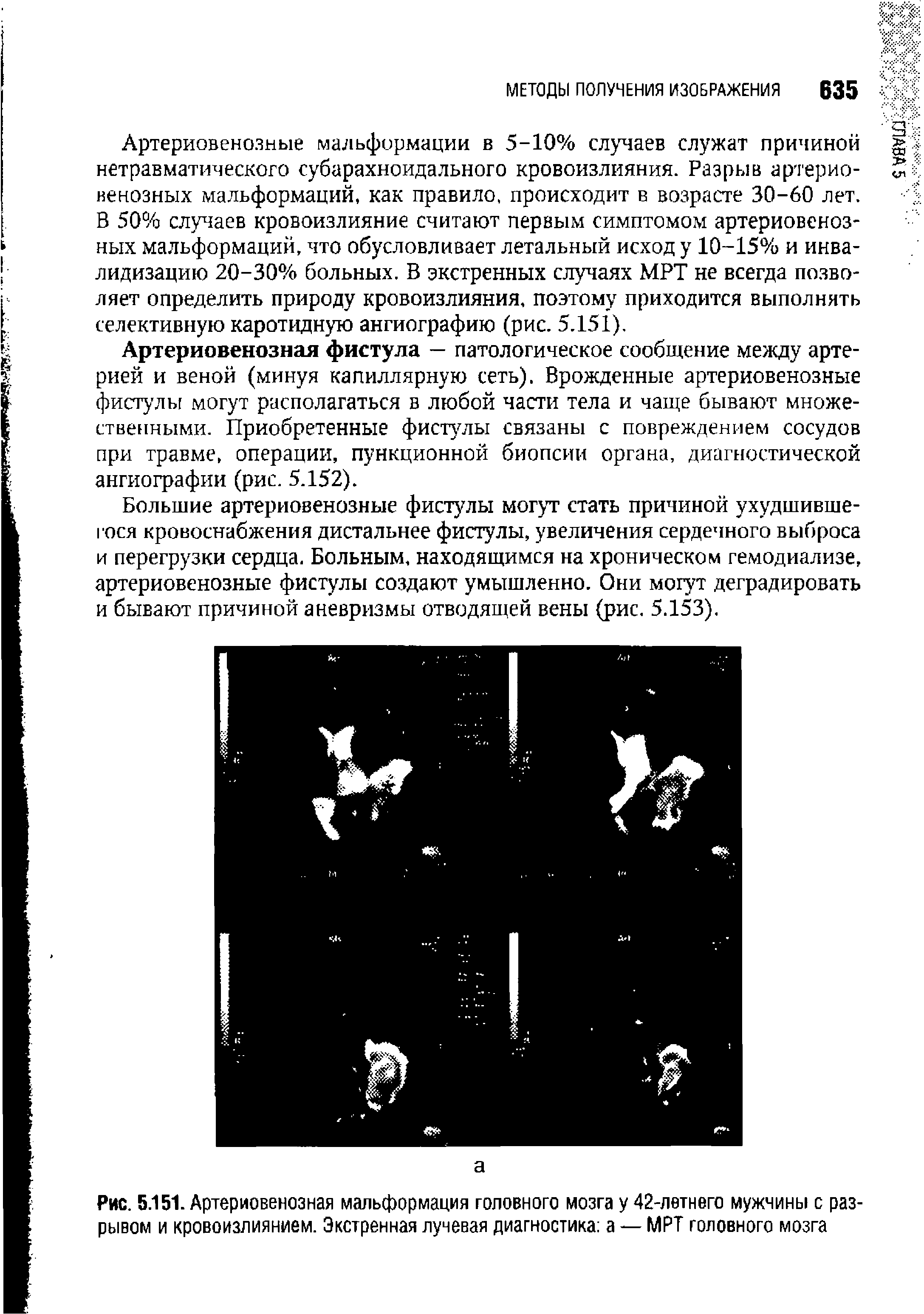 Рис. 5.151. Артериовенозная мальформация головного мозга у 42-лвтнего мужчины с разрывом и кровоизлиянием. Экстренная лучевая диагностика а — МРТ головного мозга...