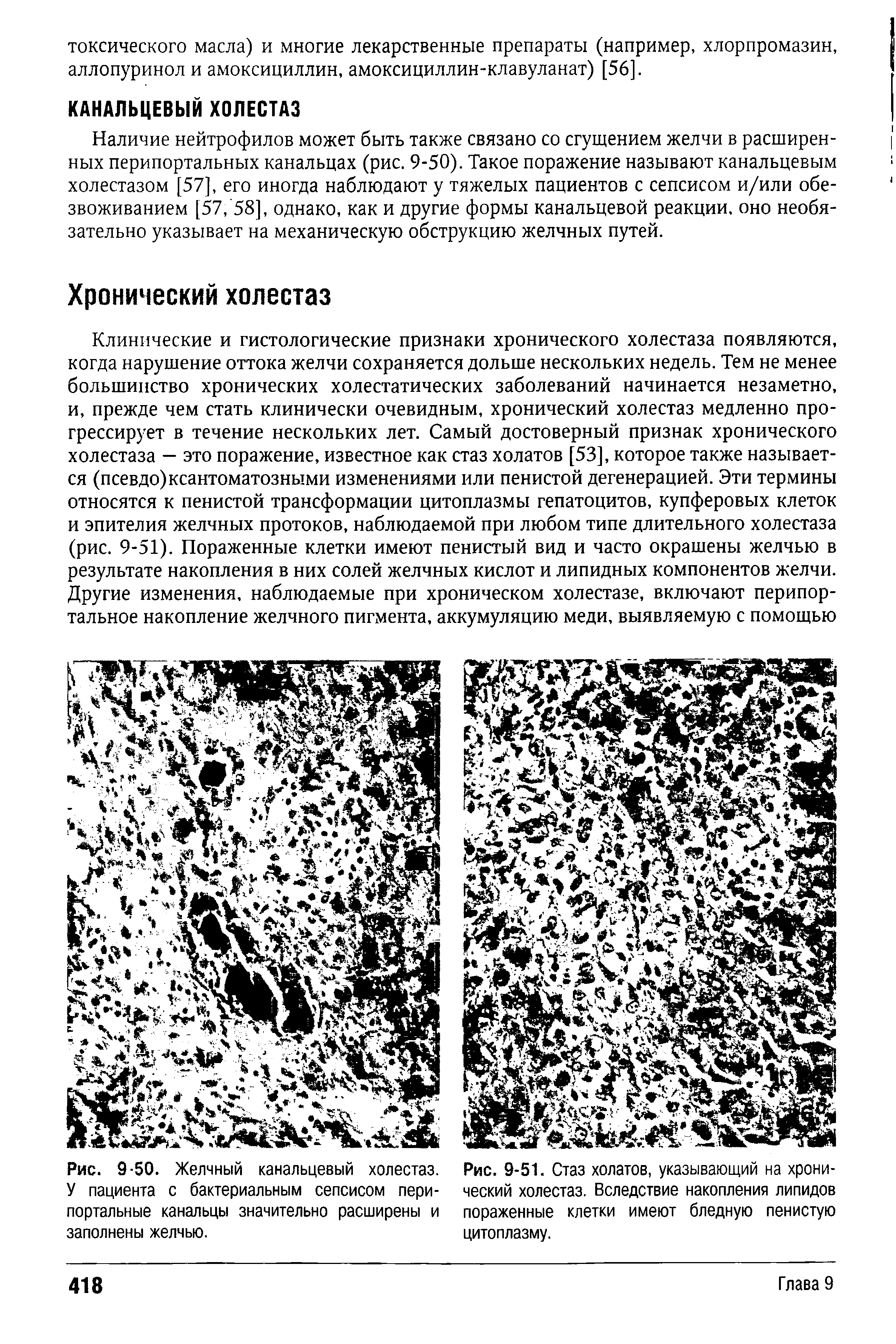 Рис. 9-50. Желчный канальцевый холестаз. У пациента с бактериальным сепсисом пери-портальные канальцы значительно расширены и заполнены желчью.