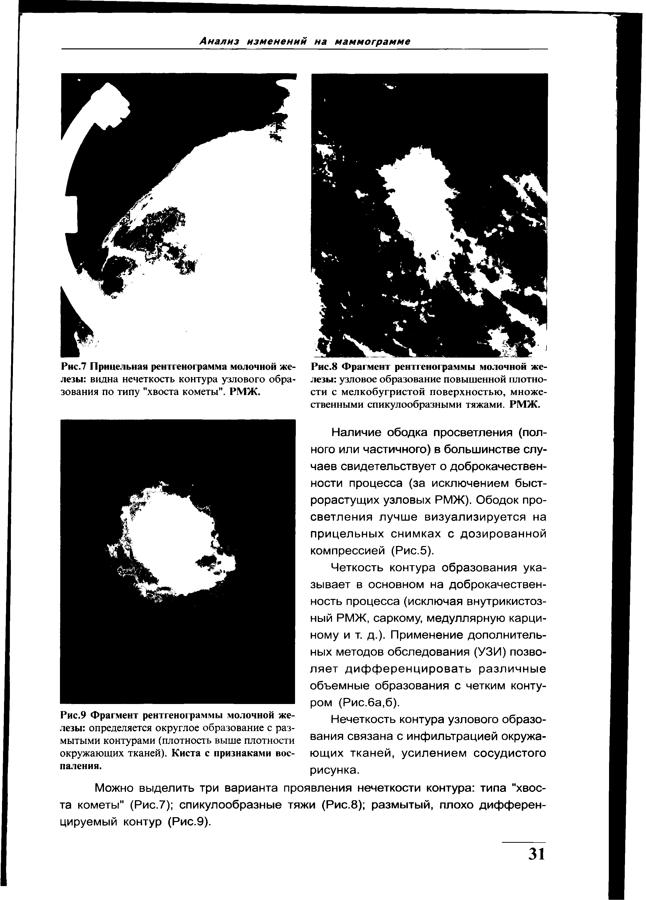 Рис.9 Фрагмент рентгенограммы молочной железы определяется округлое образование с размытыми контурами (плотность выше плотности окружающих тканей). Киста с признаками воспаления.