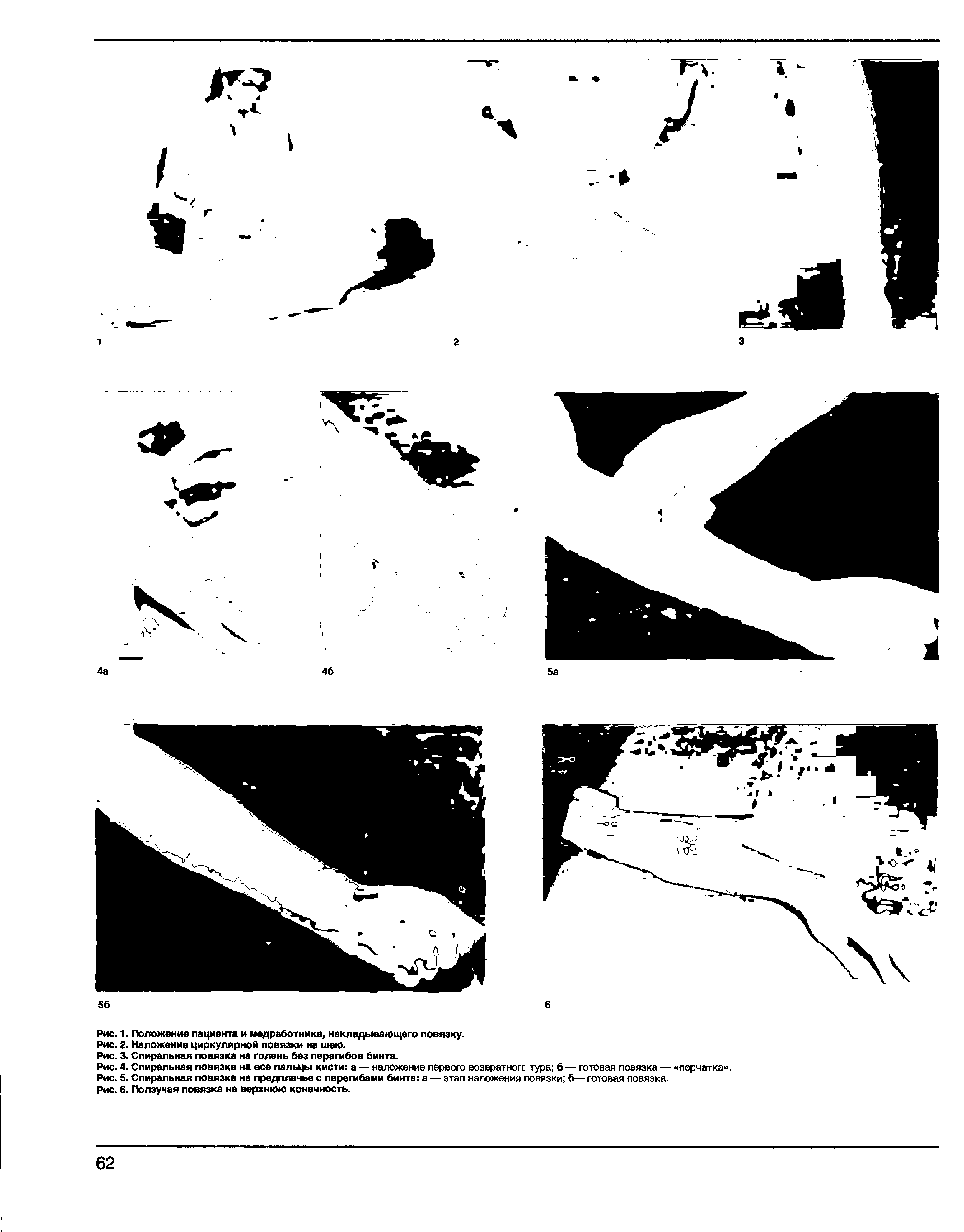 Рис. 4. Спиральная повязке на все пальцы кисти а — наложение первого возвратной тура 6 — готовая повязка — перчатка . Рис. 5. Спиральная повязка на предплечье с перегибами бинта а — этап наложения повязки б— готовая повязка.