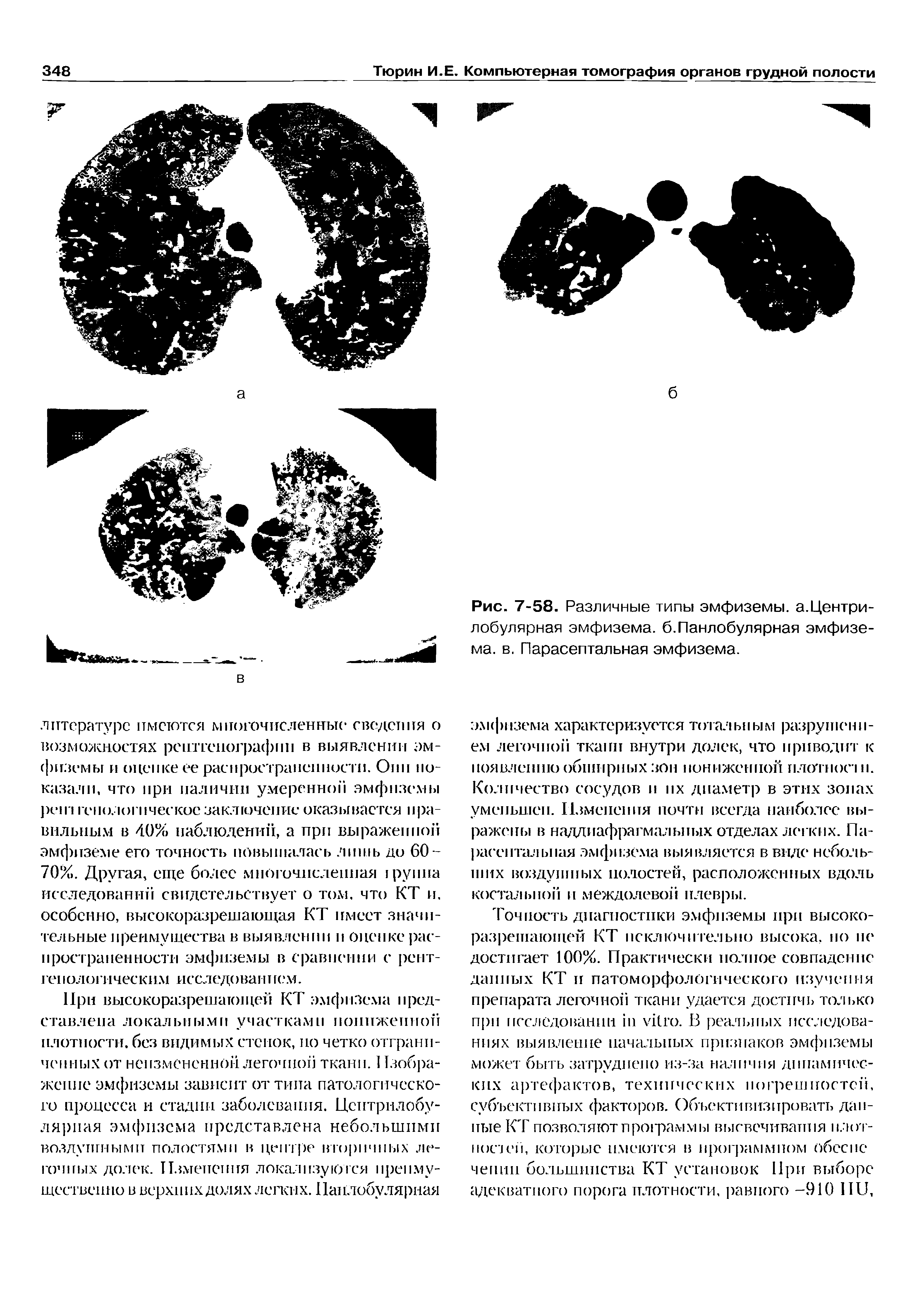 Рис. 7-58. Различные типы эмфиземы, а.Центрилобулярная эмфизема, б.Панлобулярная эмфизема. в. Парасептальная эмфизема.