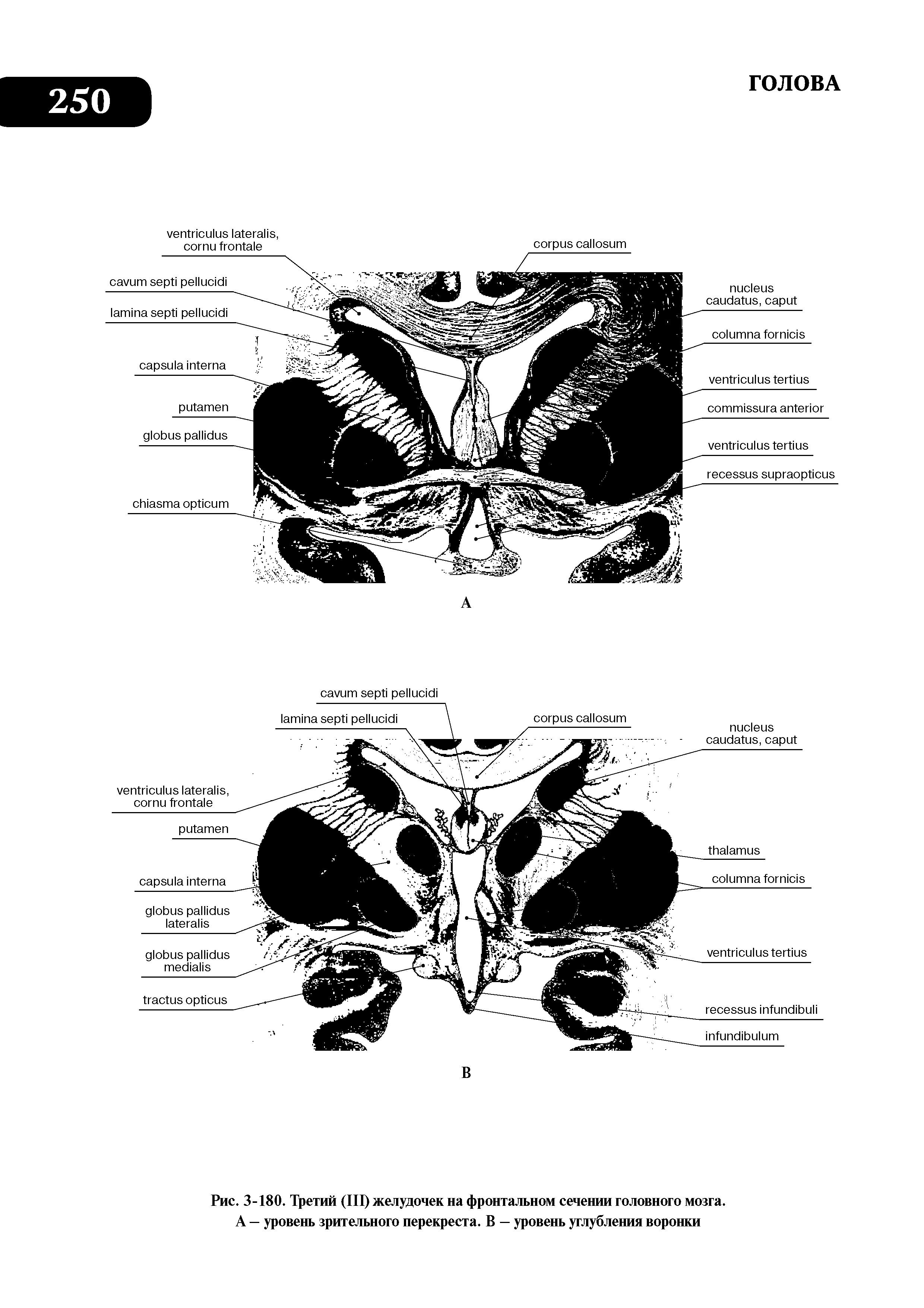 Рис. 3-180. Третий (III) желудочек на фронтальном сечении головного мозга. А — уровень зрительного перекреста. В — уровень углубления воронки...