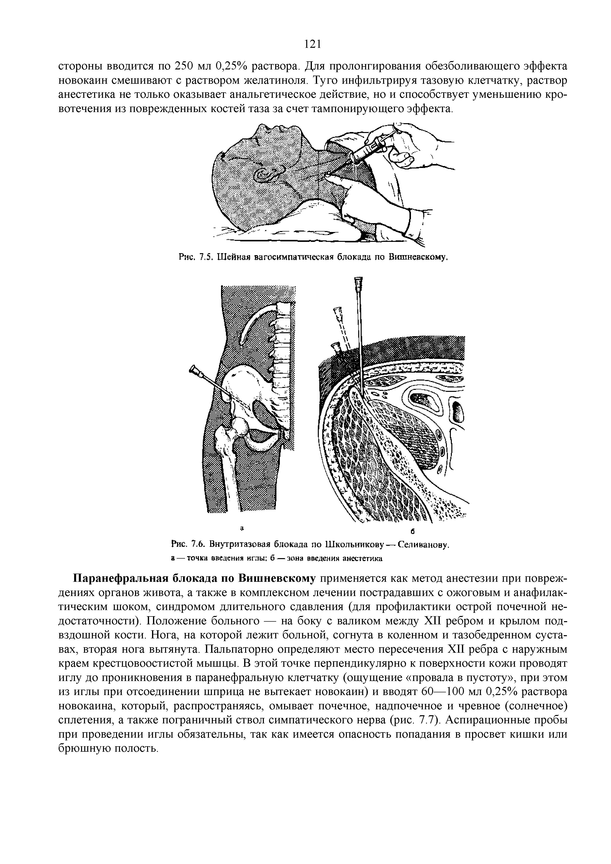 Рис. 7.6. Внутри тазовая блокада по Школьникову —Селиванову, а — точка введения иглы б — зона введения анестетика...