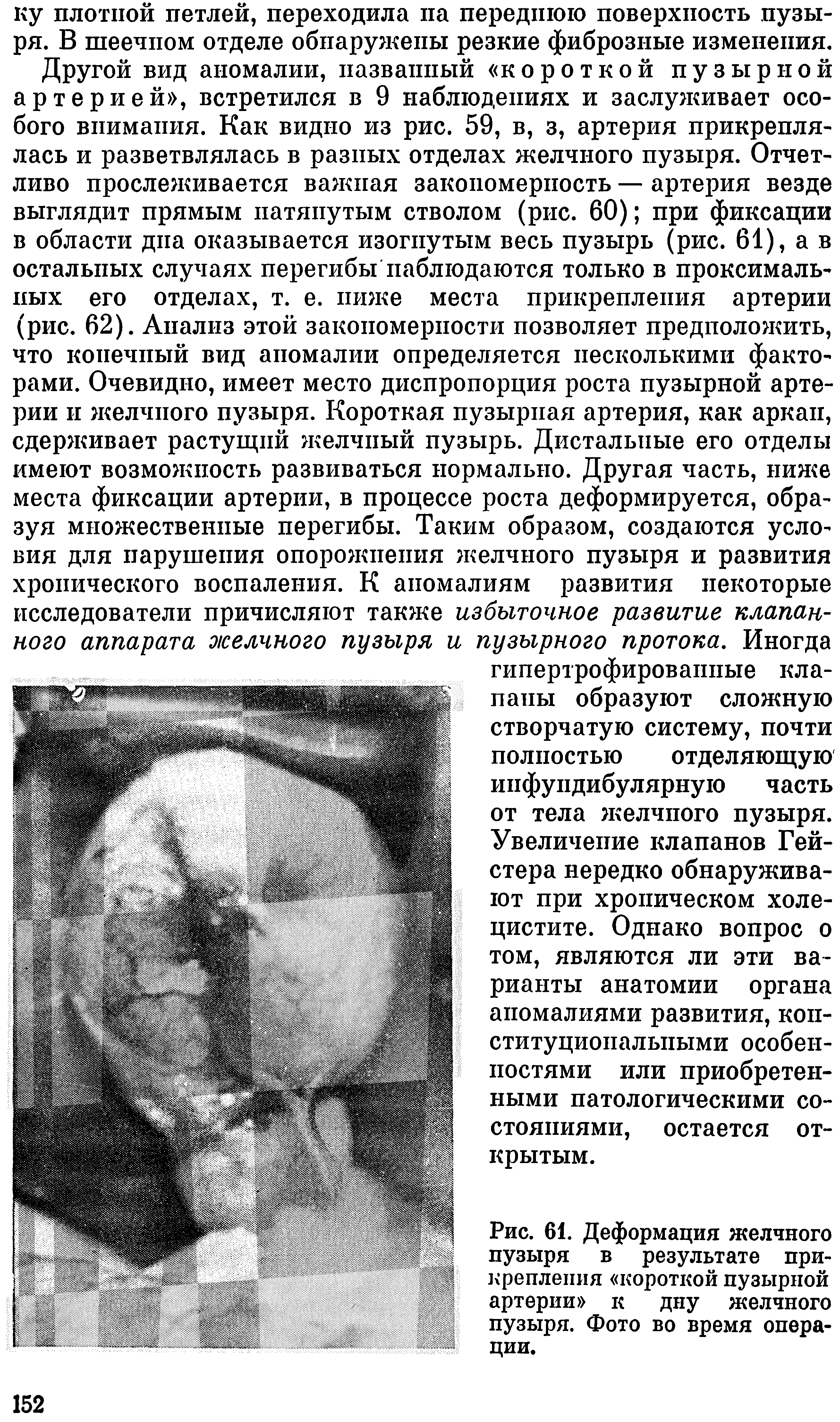 Рис. 61. Деформация желчного пузыря в результате прикрепления короткой пузырной артерии к дну желчного пузыря. Фото во время операции.