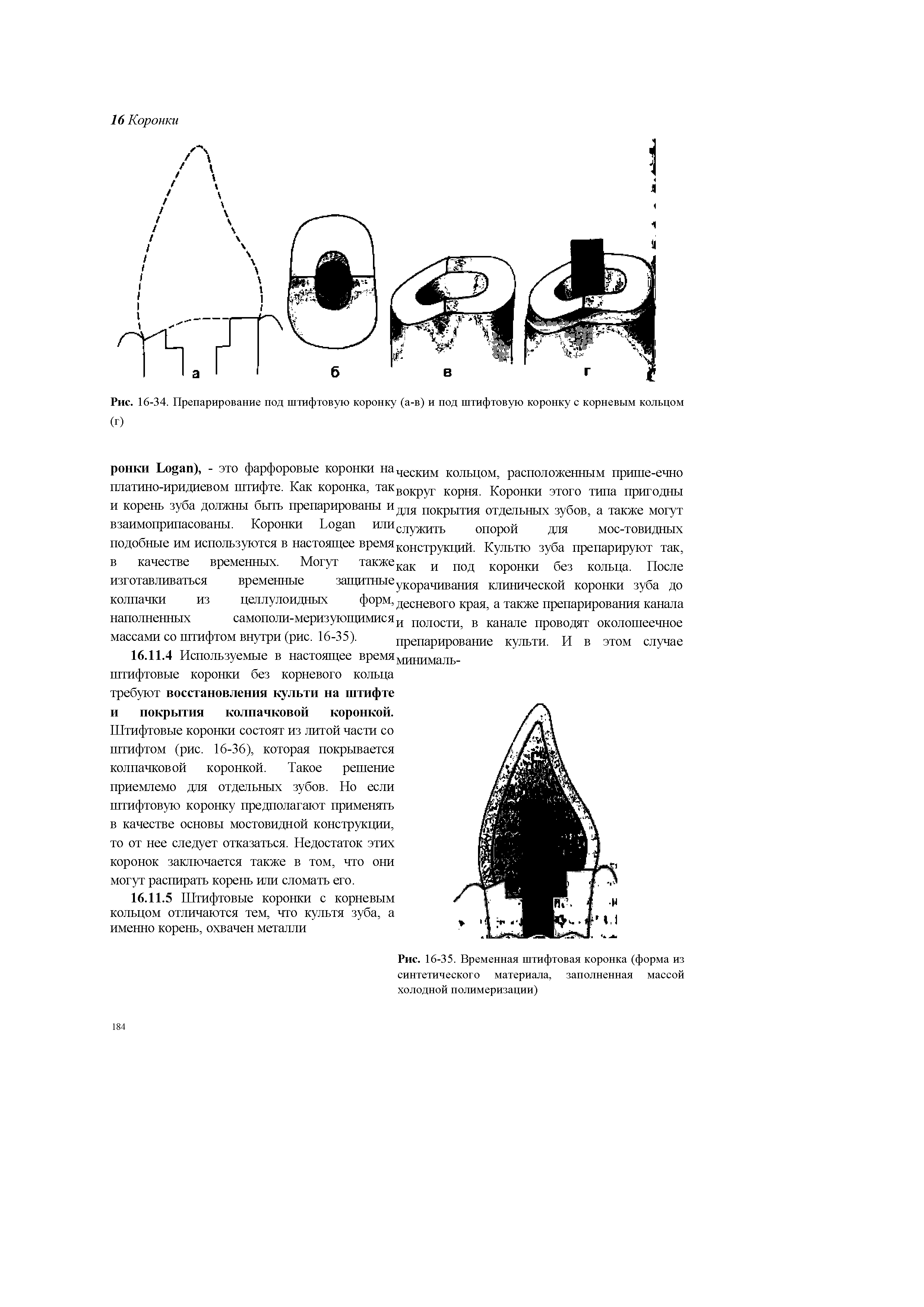 Рис. 16-35. Временная штифтовая коронка (форма из синтетического материала, заполненная массой холодной полимеризации)...