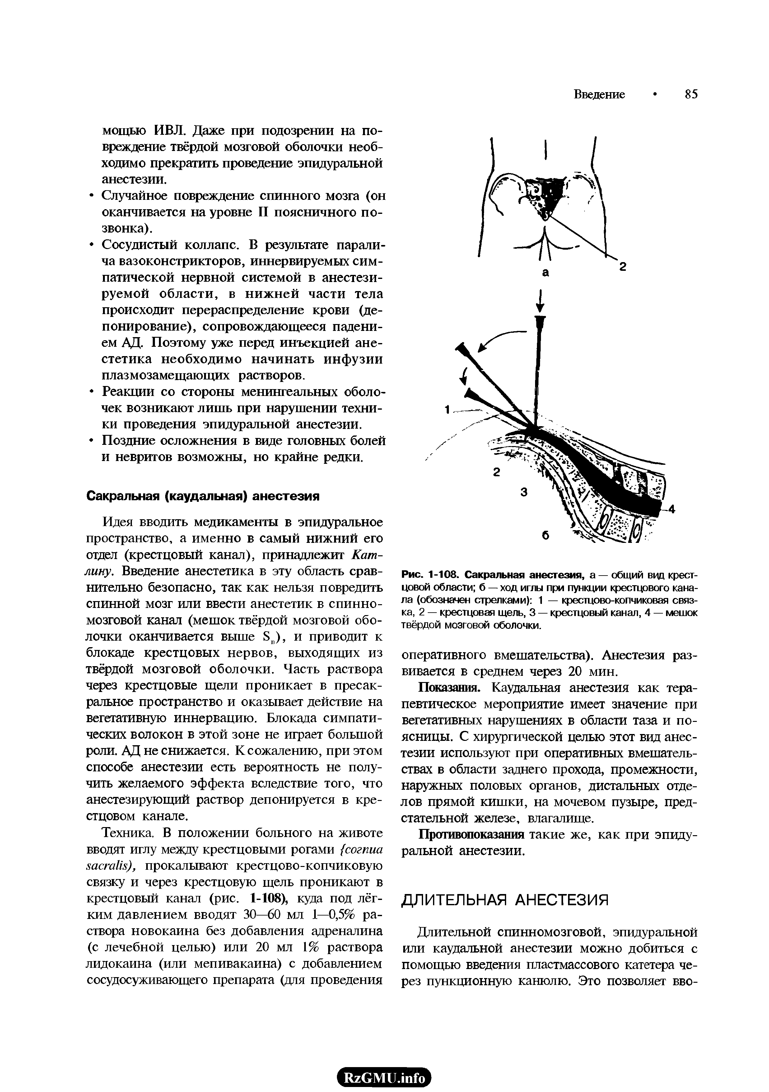 Рис. 1-108. Сакральная анестезия, а — общий вид крестцовой области б — ход иглы при пункции крестцового канала (обозначен стрелками) 1 — крестцово-копчиковая связка, 2 — крестцовая щель, 3 — крестцовый канал, 4 — мешок твёрдой мозговой оболочки.