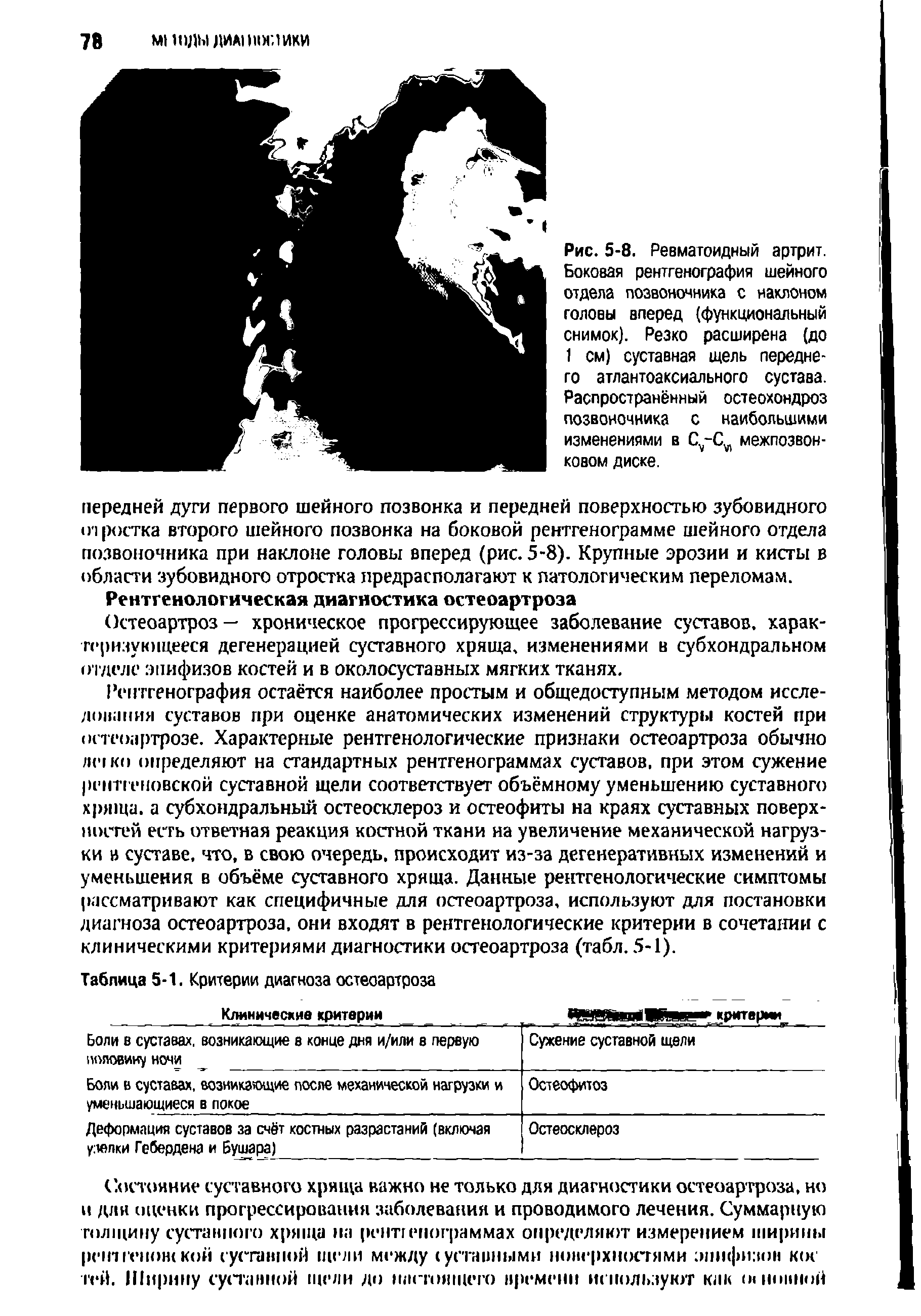 Рис. 5-8. Ревматоидный артрит. Боковая рентгенография шейного отдела позвоночника с наклоном головы вперед (функциональный снимок). Резко расширена (до 1 см) суставная щель переднего атлантоаксиального сустава. Распространённый остеохондроз позвоночника с наибольшими изменениями в С -С.Л межпозвонковом диске.