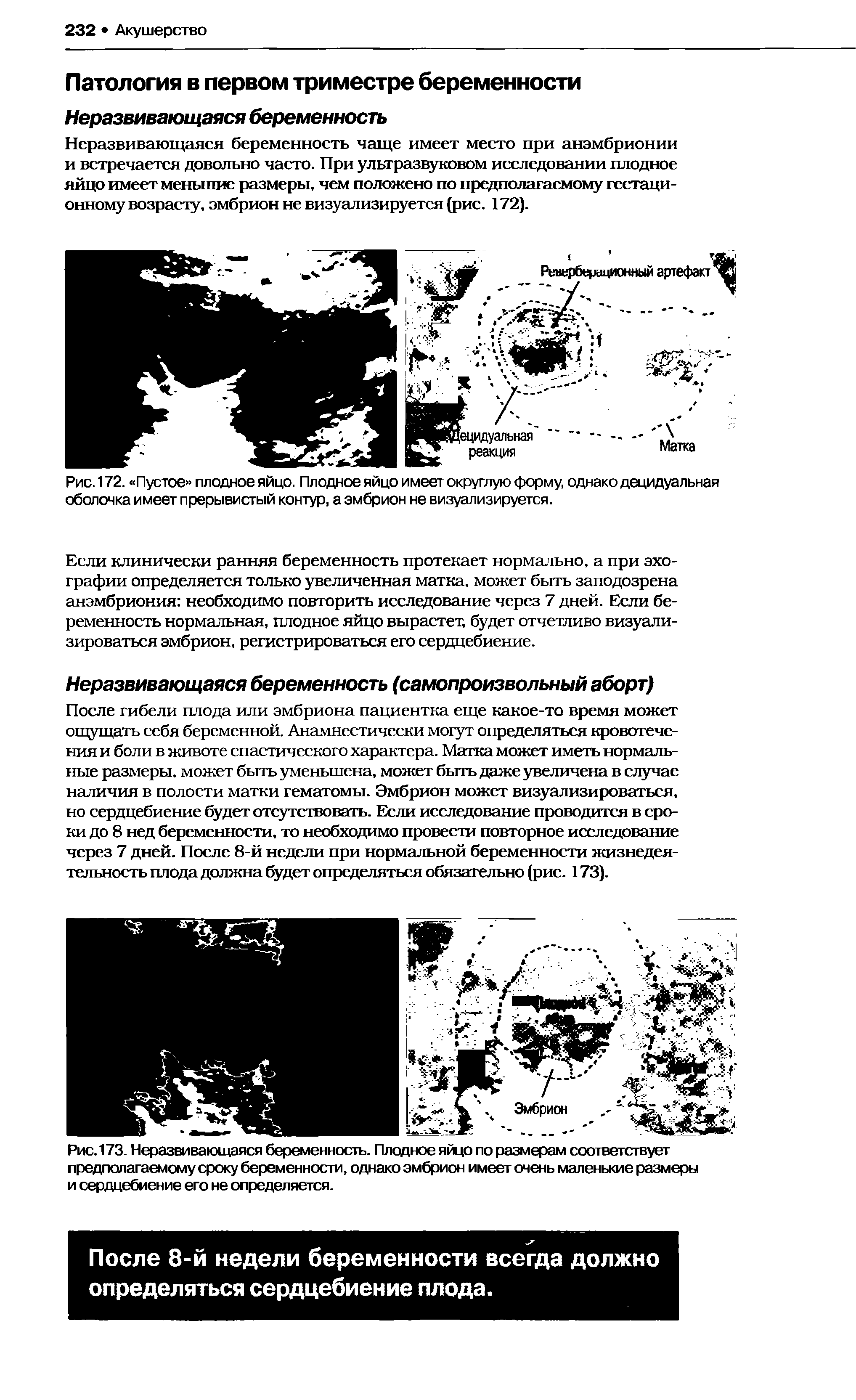 Рис. 173. Неразвивающаяся беременность. Плодное яйцо по размерам соответствует предполагаемому сроку беременности, однако эмбрион имеет очень маленькие размеры и сердцебиение его не определяется.