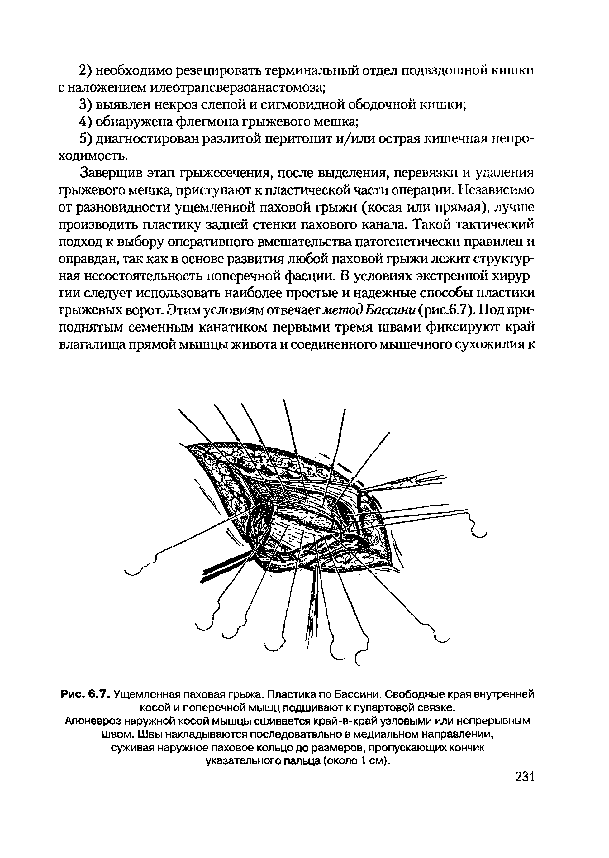 Рис. 6.7. Ущемленная паховая грыжа. Пластика по Бассини. Свободные края внутренней косой и поперечной мышц подшивают к пупартовой связке.