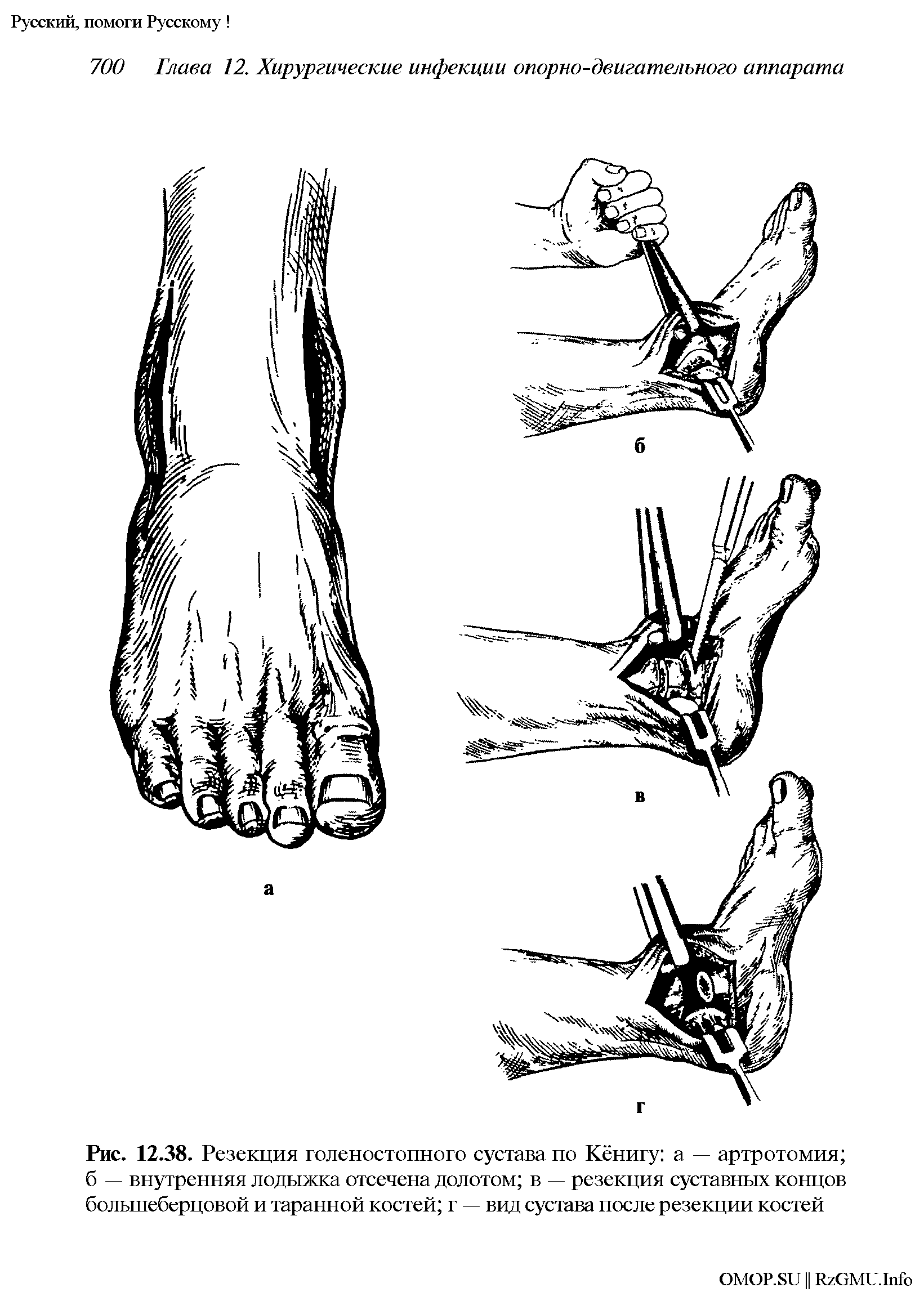 Рис. 12.38. Резекция голеностопного сустава по Кёнигу а — артротомия б — внутренняя лодыжка отсечена долотом в — резекция суставных концов большеберцовой и таранной костей г — вид сустава после резекции костей...