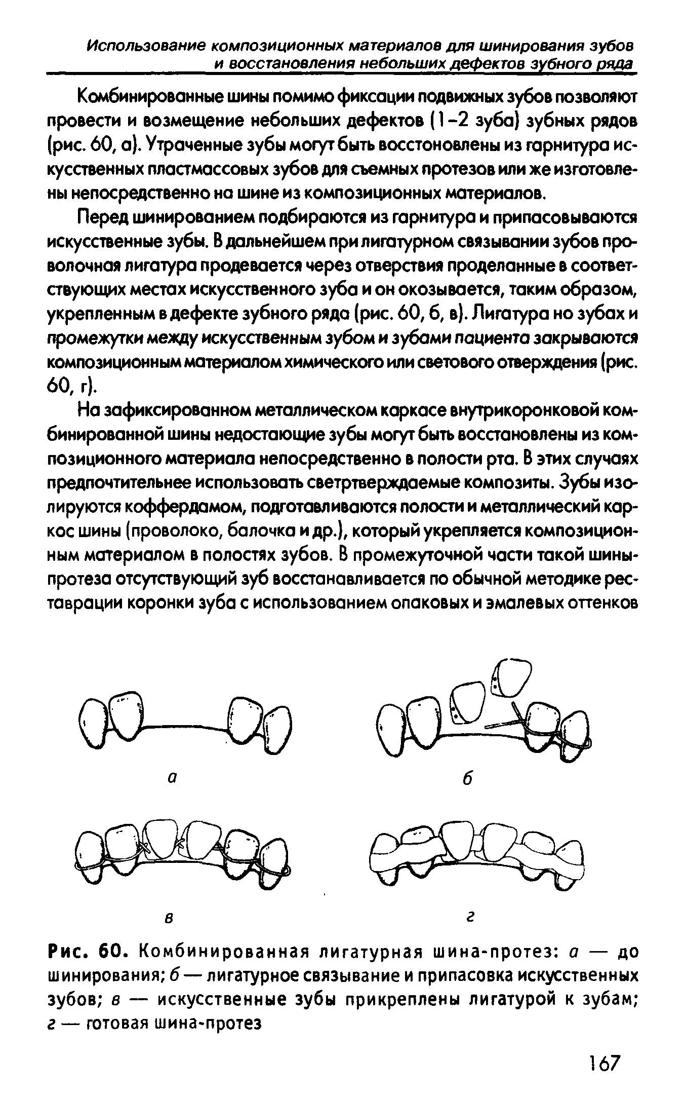 Рис. 60. Комбинированная лигатурная шина-протез о — до шинирования б—лигатурное связывание и припасовка искусственных зубов в — искусственные зубы прикреплены лигатурой к зубам г — готовая шина-протез...