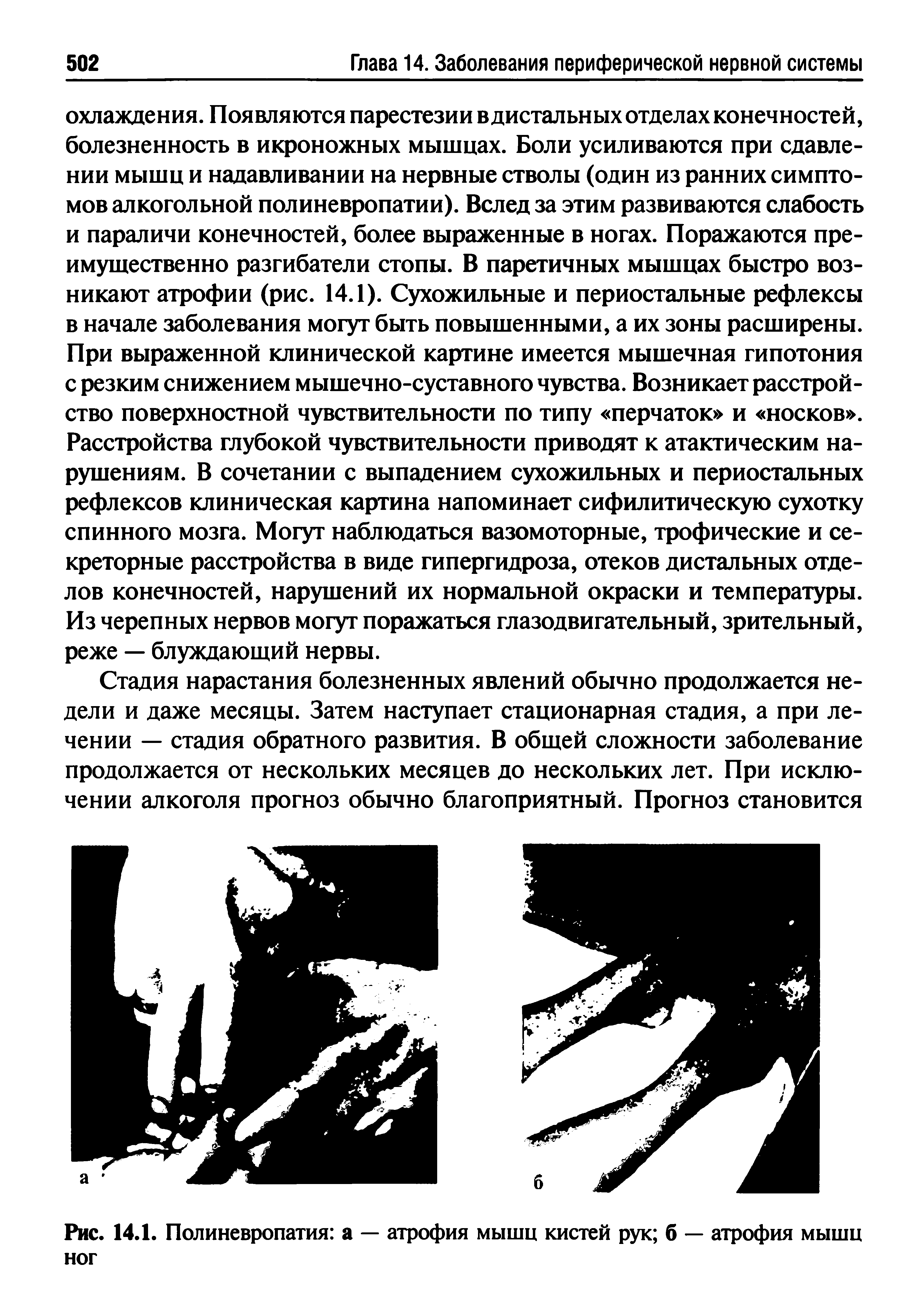 Рис. 14.1. Полиневропатия а — атрофия мышц кистей рук б — атрофия мышц ног...