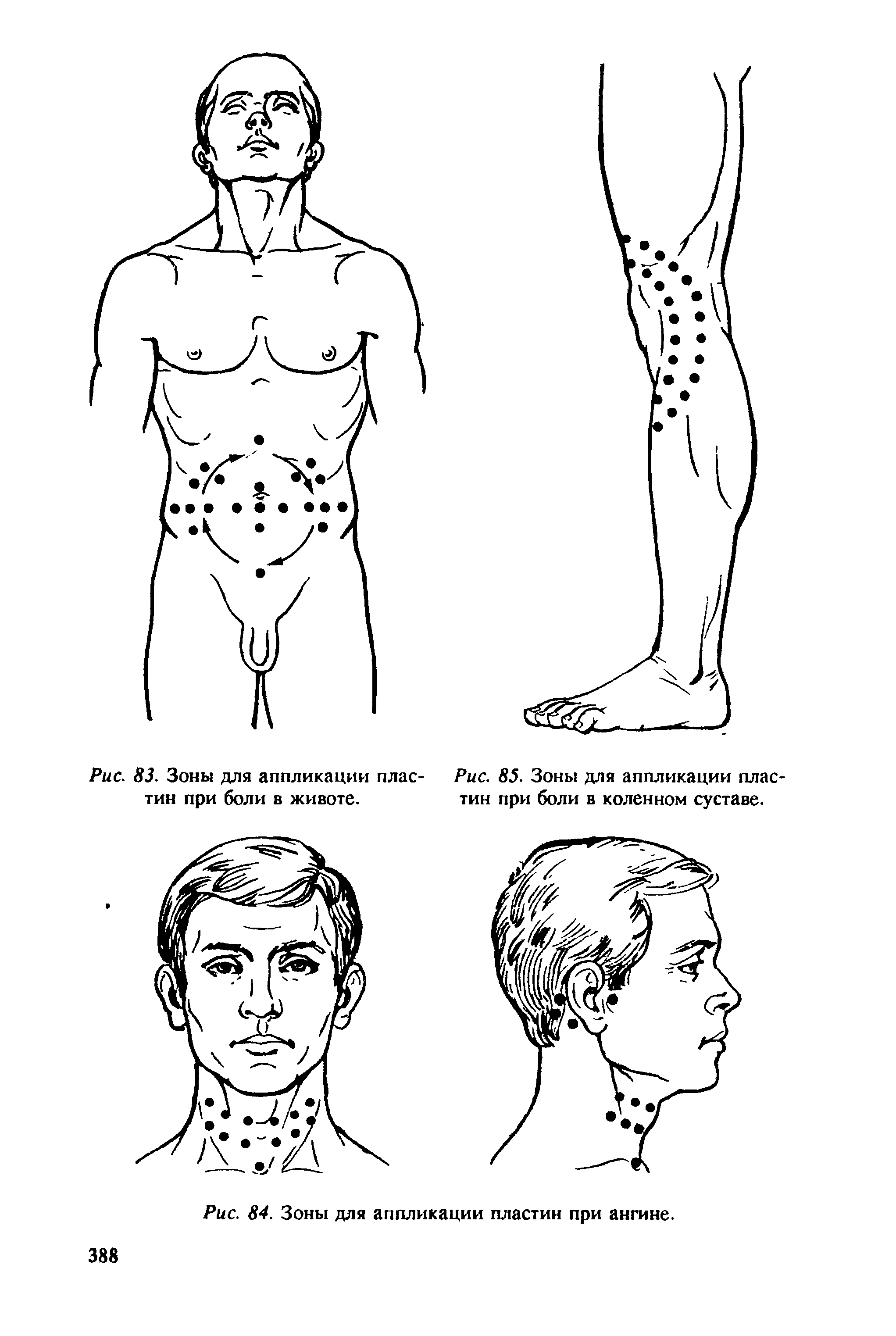 Рис. 85. Зоны для аппликации пластин при боли в коленном суставе.