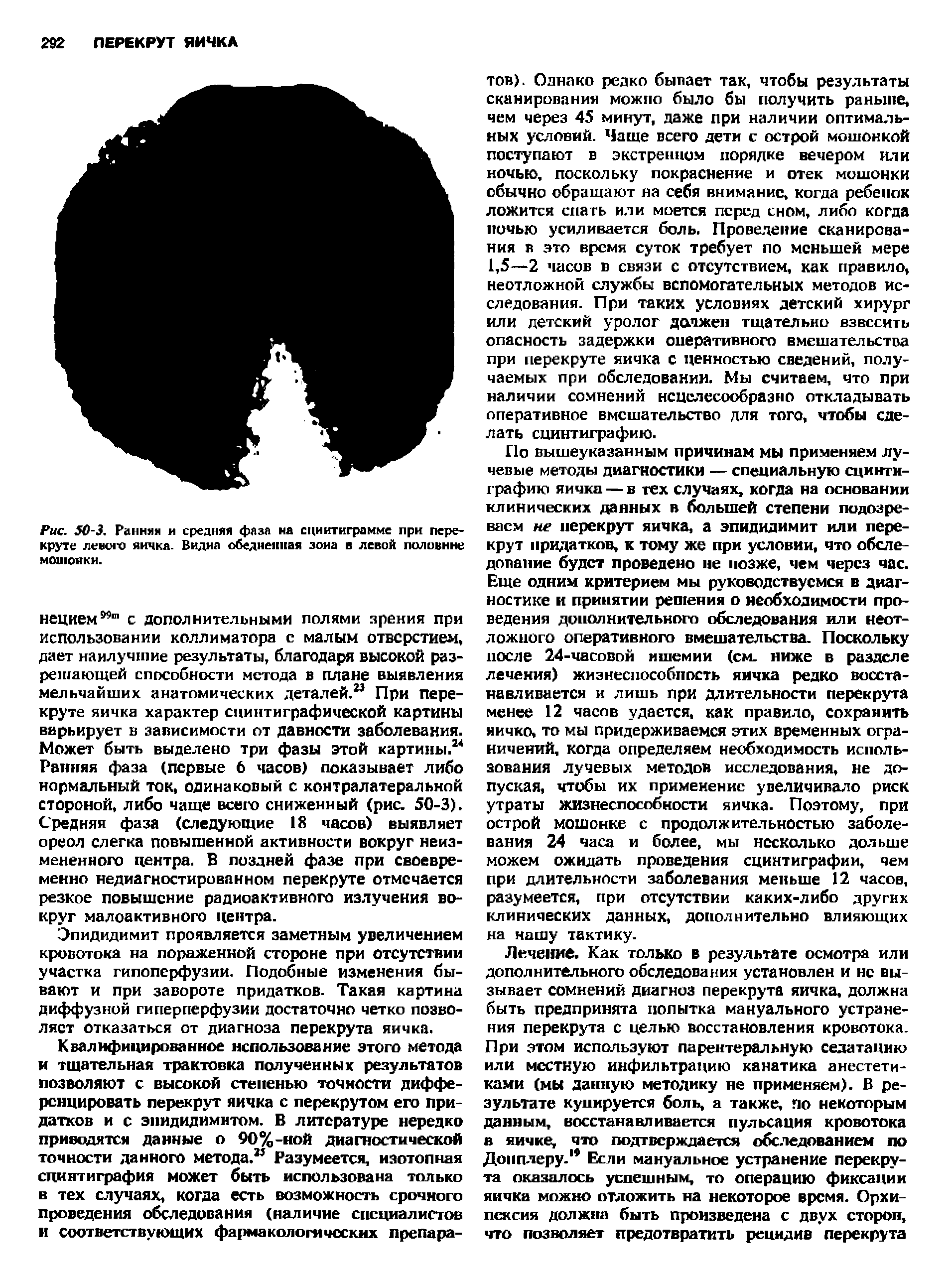 Рис. 50-3. Ранняя и средняя фаза на сциитиграмме при перекрути левого яичка. Видна обедненная зона в левой половине мошонки.