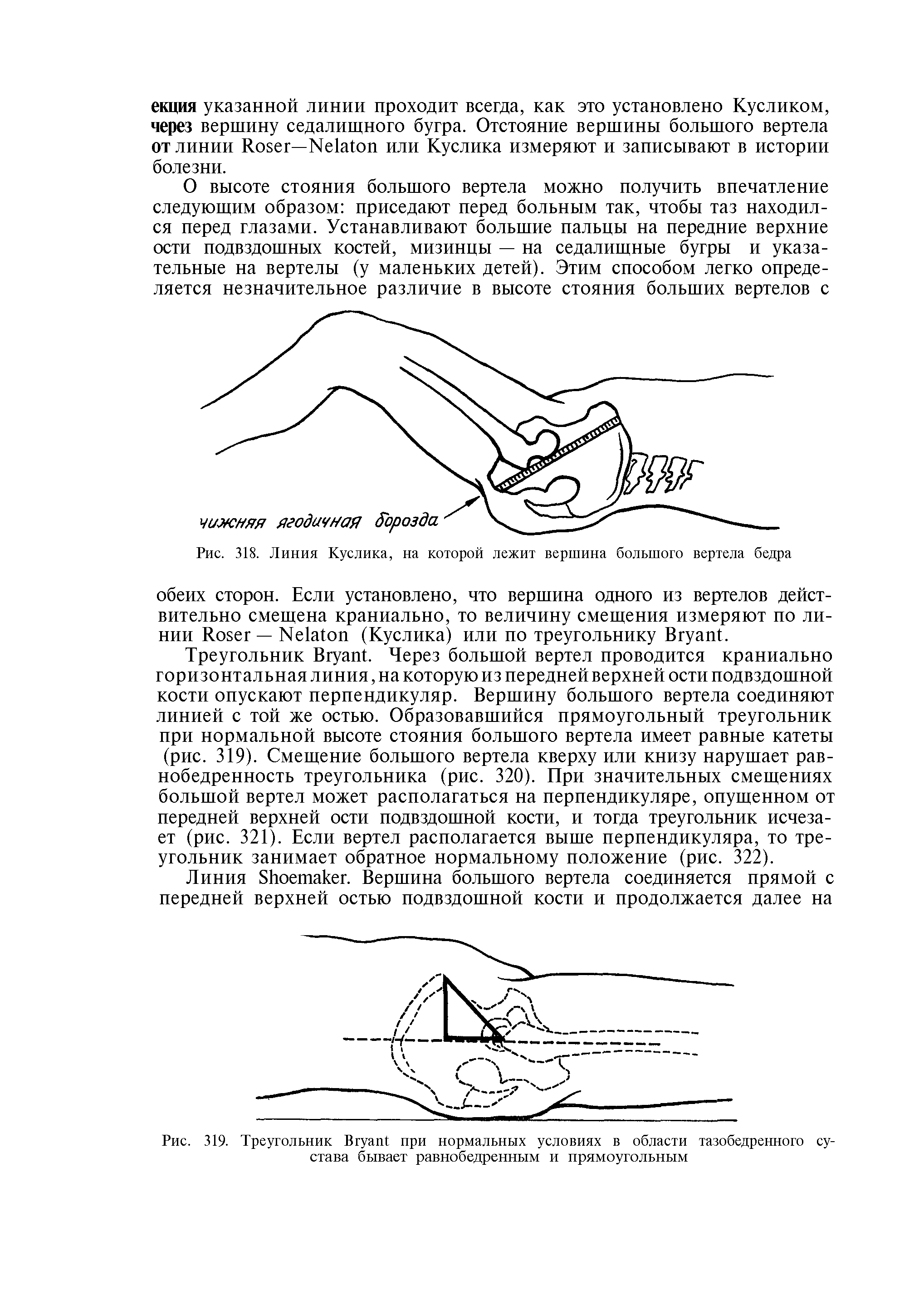 Рис. 319. Треугольник B при нормальных условиях в области тазобедренного сустава бывает равнобедренным и прямоугольным...