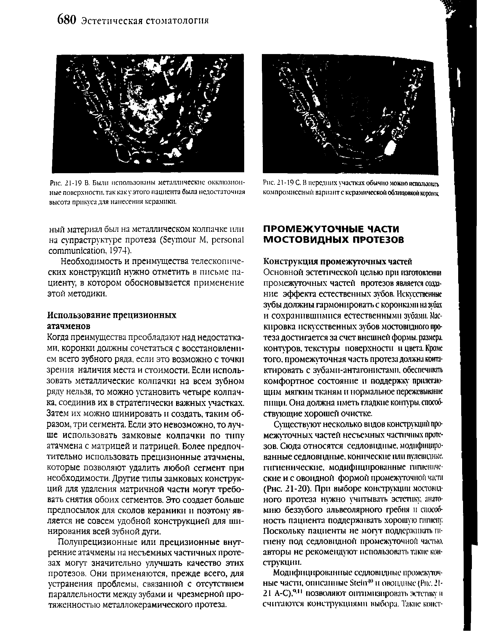 Рис. 21 -19 С. В передних участках обычно можно испачмоиать компромиссный вариант с керамической облицовкой коронок...