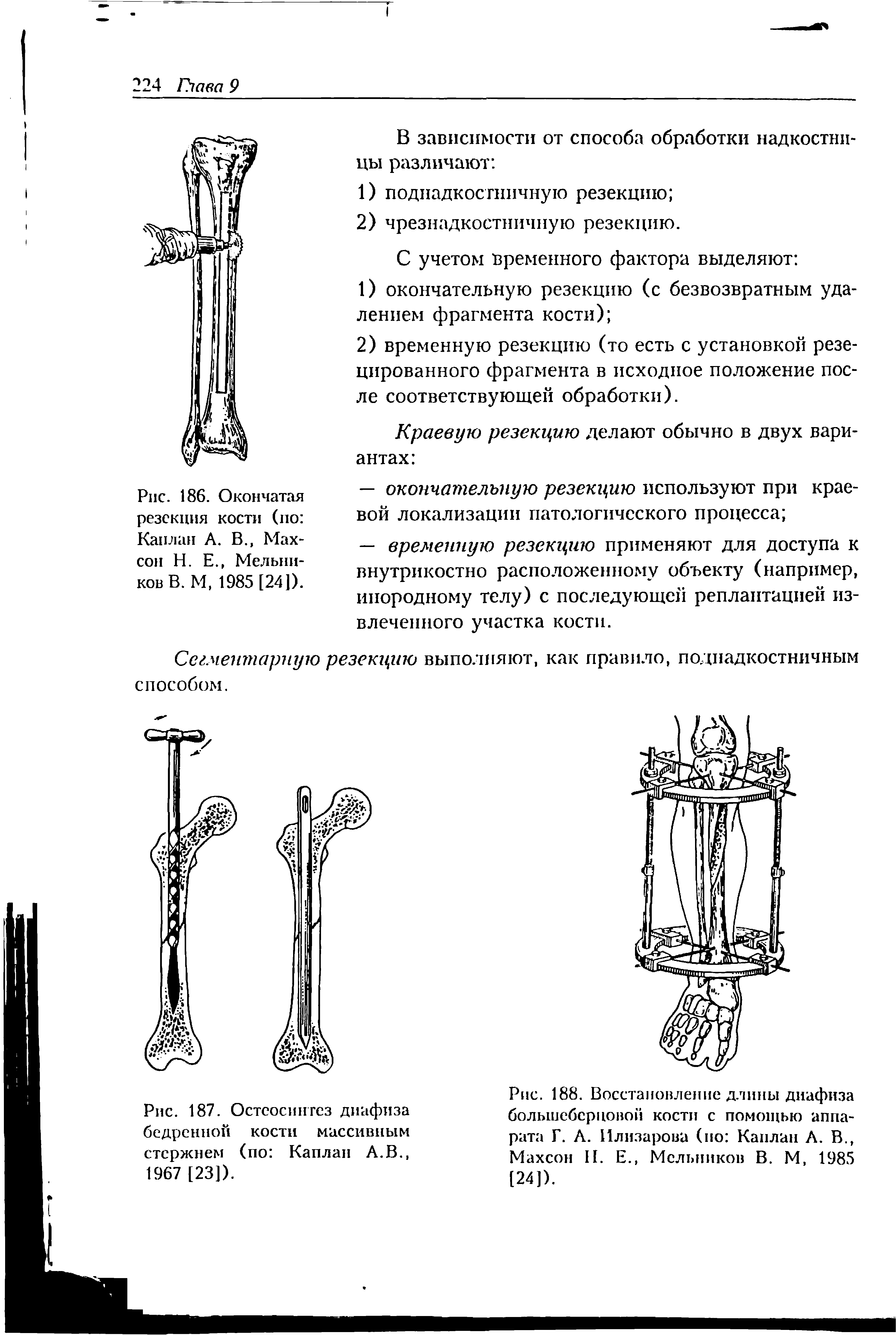 Рис. 188. Восстановление длины диафиза большеберцовой кости с помощью аппарата Г. А. Илизарова (по Каплан А. В., Махсон И. Е., Мельников В. М, 1985 [24]).