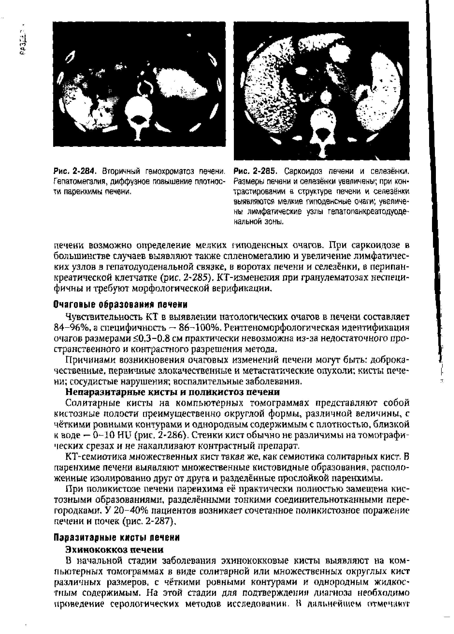 Рис. 2-285. Саркоидоз печени и селезёнки. Размеры печени и селезёнки увеличены при контрастировании а структуре печени и селезёнки выявляются мелкие гиподенсные очаги увеличены лимфатические узлы гепатопанкреатодуоде-калькой зоны.