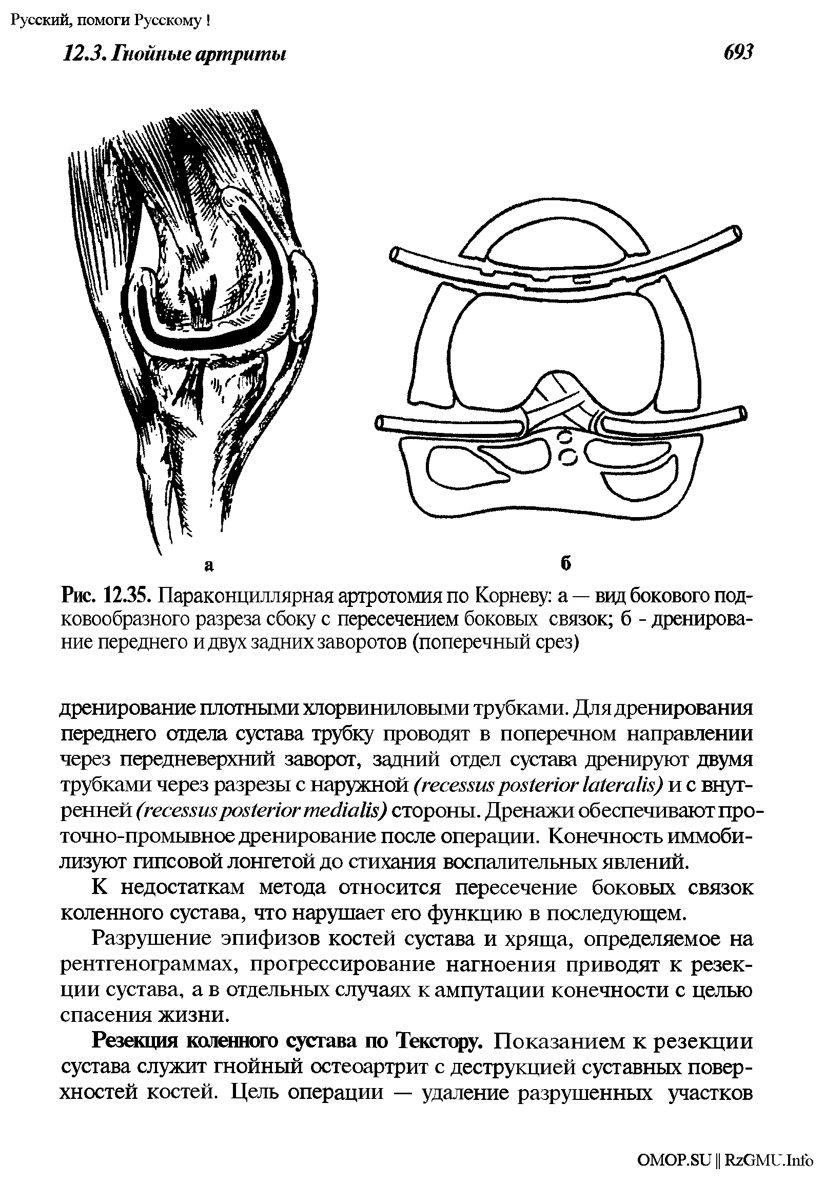 Рис. 12.35. Параконциллярная артротомия по Корневу а — вид бокового подковообразного разреза сбоку с пересечением боковых связок б - дренирование переднего и двух задних заворотов (поперечный срез)...