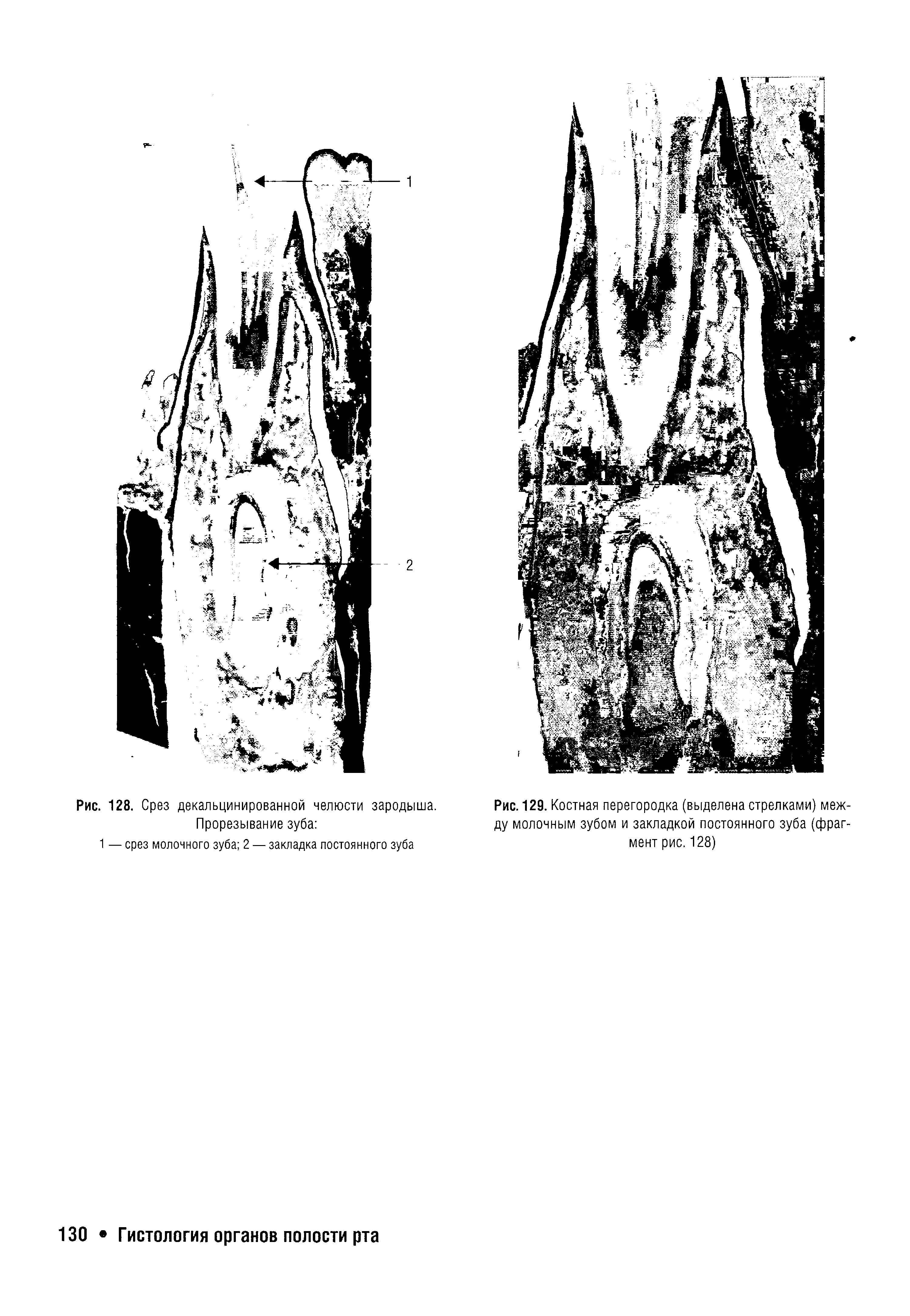 Рис. 129. Костная перегородка (выделена стрелками) между молочным зубом и закладкой постоянного зуба (фрагмент рис. 128)...