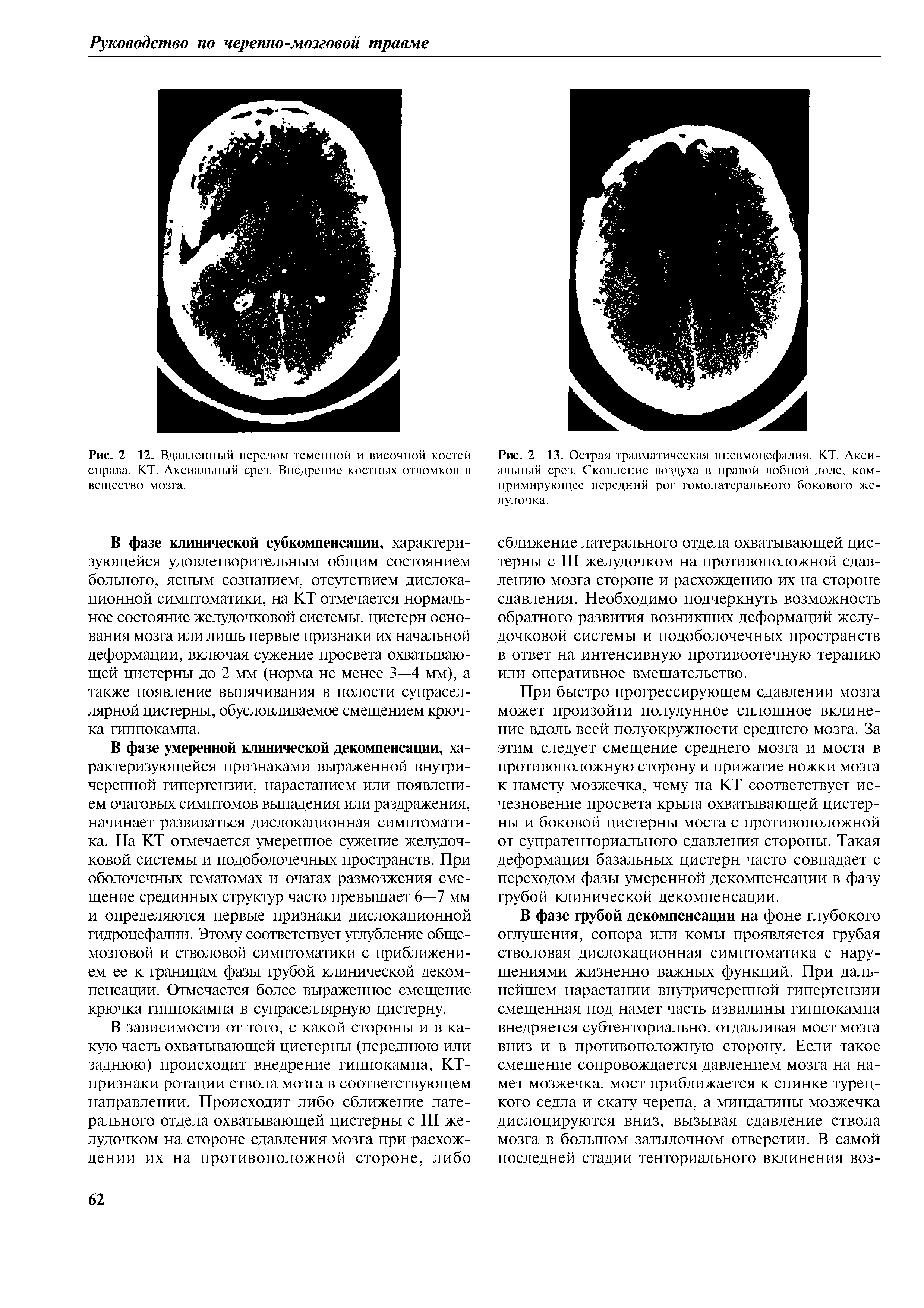 Рис. 2—13. Острая травматическая пневмоцефалия. КТ. Аксиальный срез. Скопление воздуха в правой лобной доле, компримирующее передний рог гомолатерального бокового желудочка.