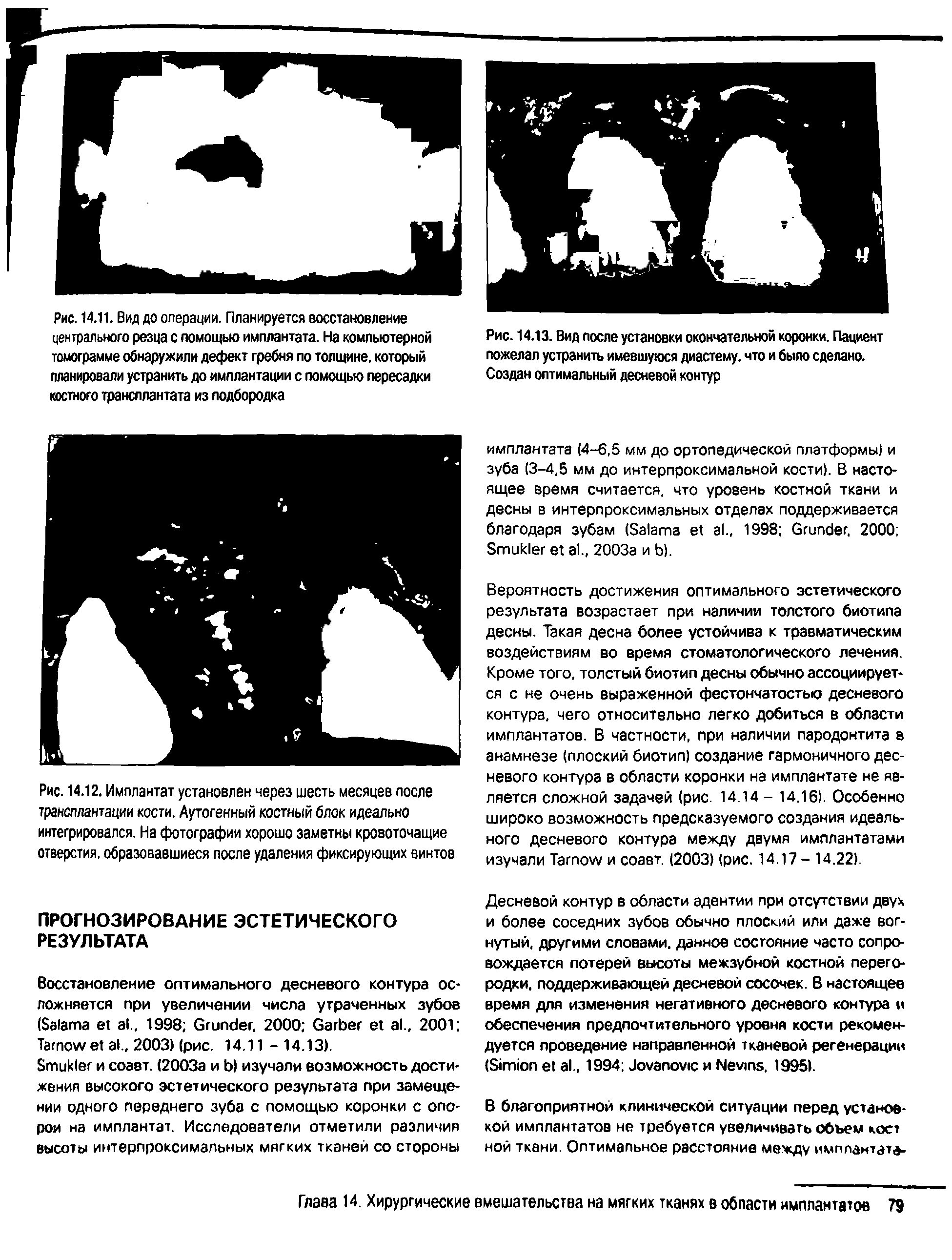 Рис. 14.12. Имплантат установлен через шесть месяцев после трансплантации кости. Аутогенный костный блок идеально интегрировался. На фотографии хорошо заметны кровоточащие отверстия, образовавшиеся после удаления фиксирующих винтов...