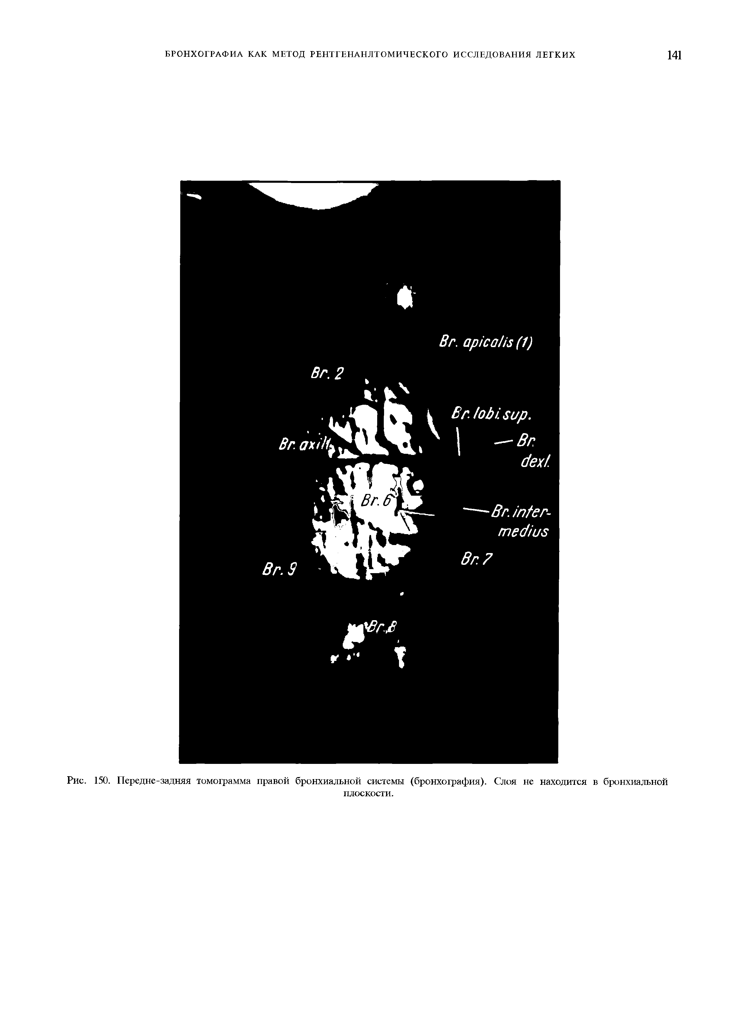 Рис. 150. Передне-задняя томограмма правой бронхиальной системы (бронхография). Слоя не находится в бронхиальной плоскости.