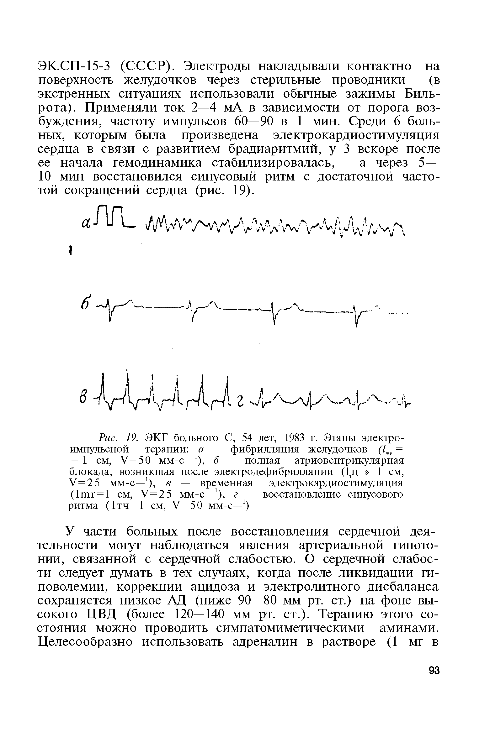 Рис. 19. ЭКГ больного С, 54 лет, 1983 г. Этапы электро-импульсной терапии а — фибрилляция желудочков (1тг = = 1 см, У=50 мм-с-1), б — полная атриовентрикулярная блокада, возникшая после электродефибрилляции (1тц= =1 см, V 2 5 мм-с—1), в — временная электрокардиостимуляция (1тг = 1 см, У=25 мм-с—1), г — восстановление синусового ритма (1тч=1 см, У=50 мм-с—1)...